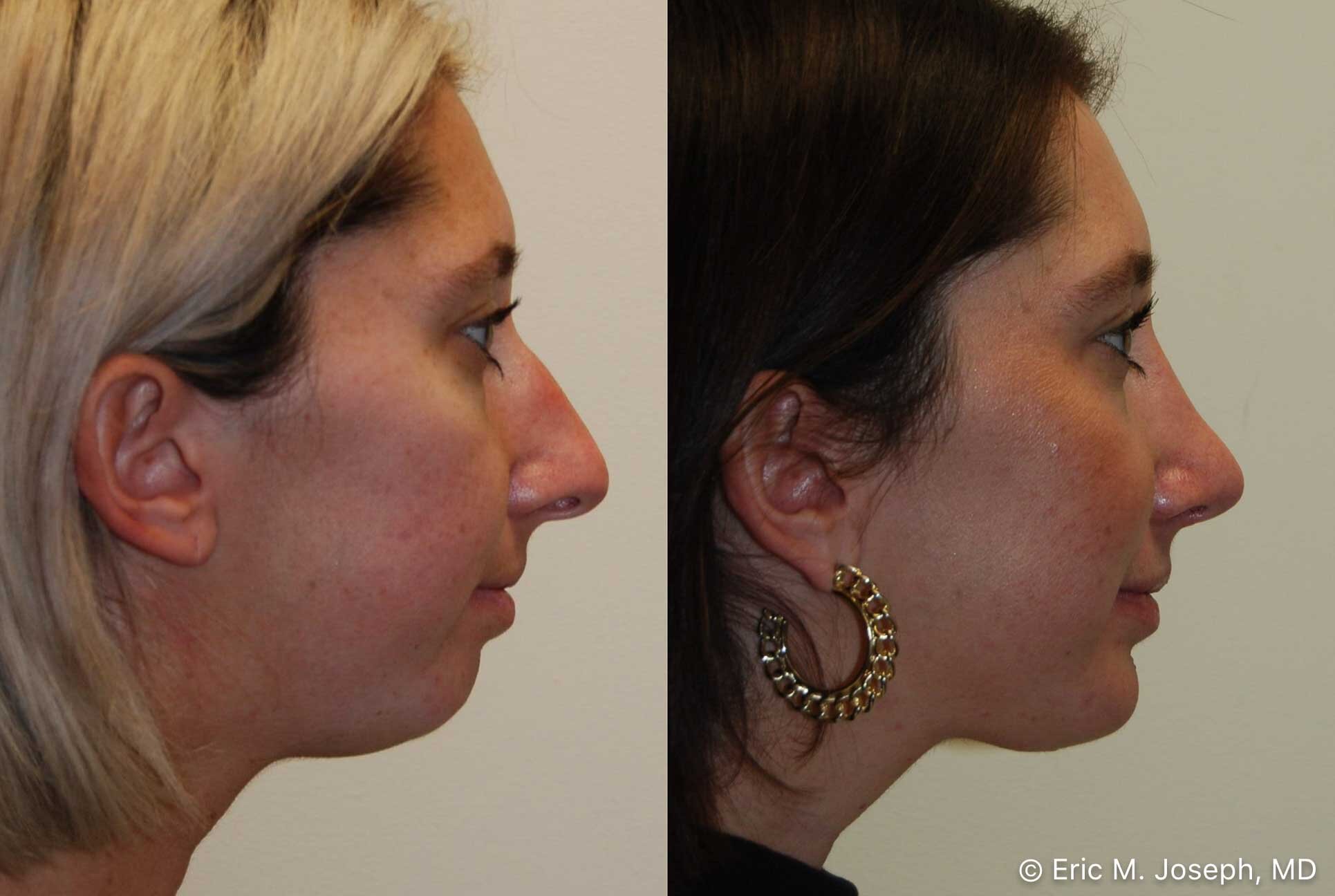 rhinoplasty-chin-implant-0894.jpg
