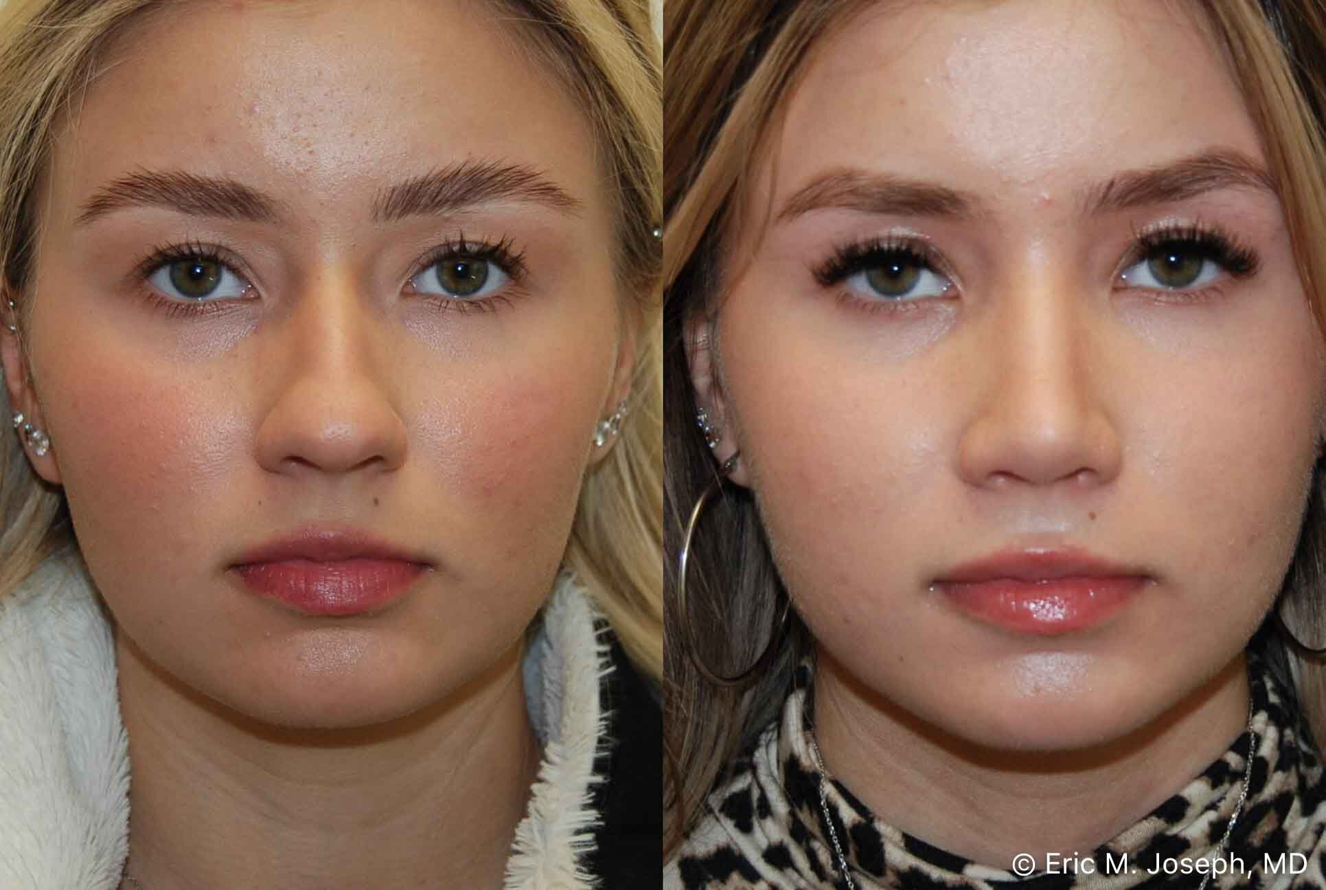primary-rhinoplasty-nj-0902.jpg