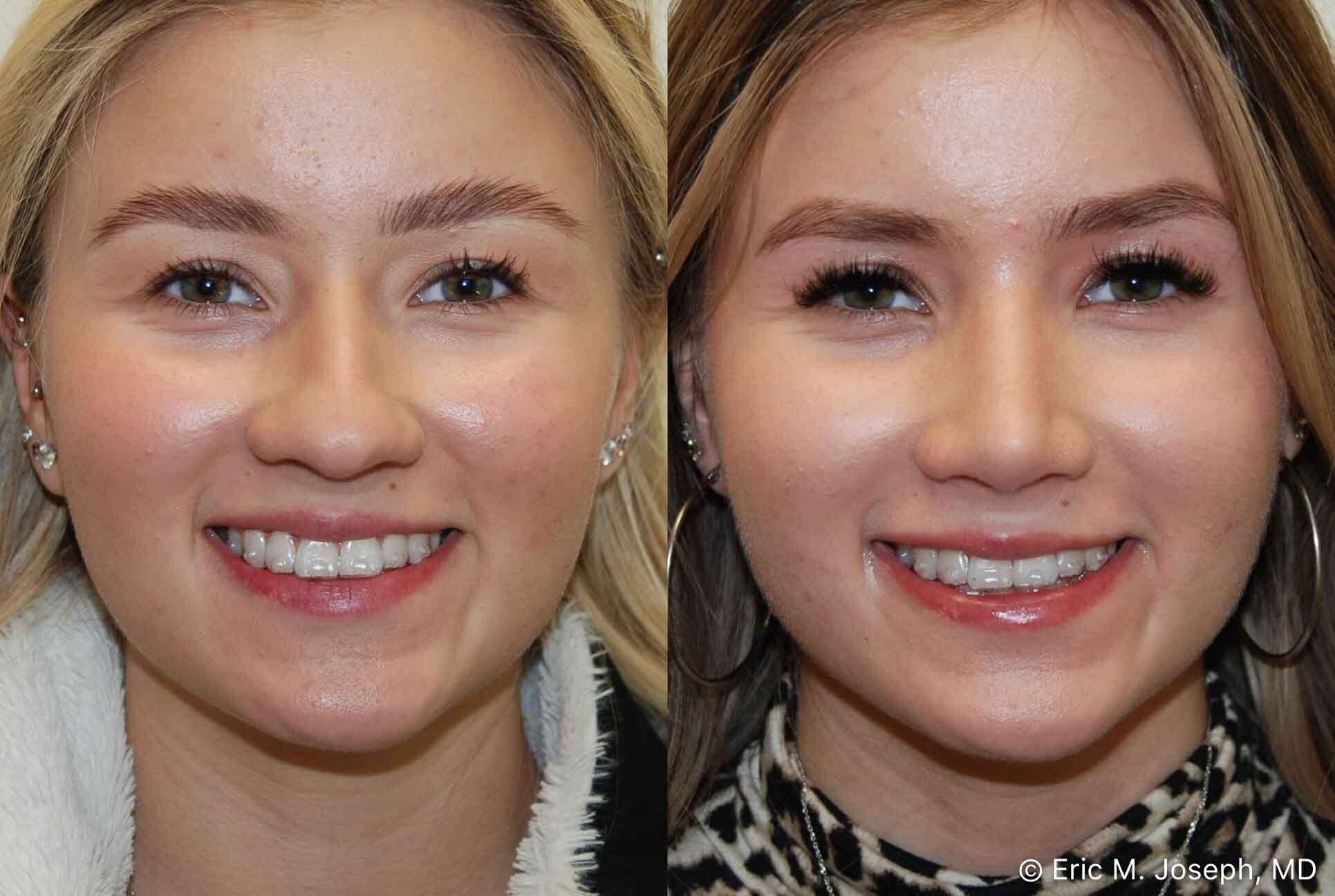 primary-rhinoplasty-nj-0903.jpg