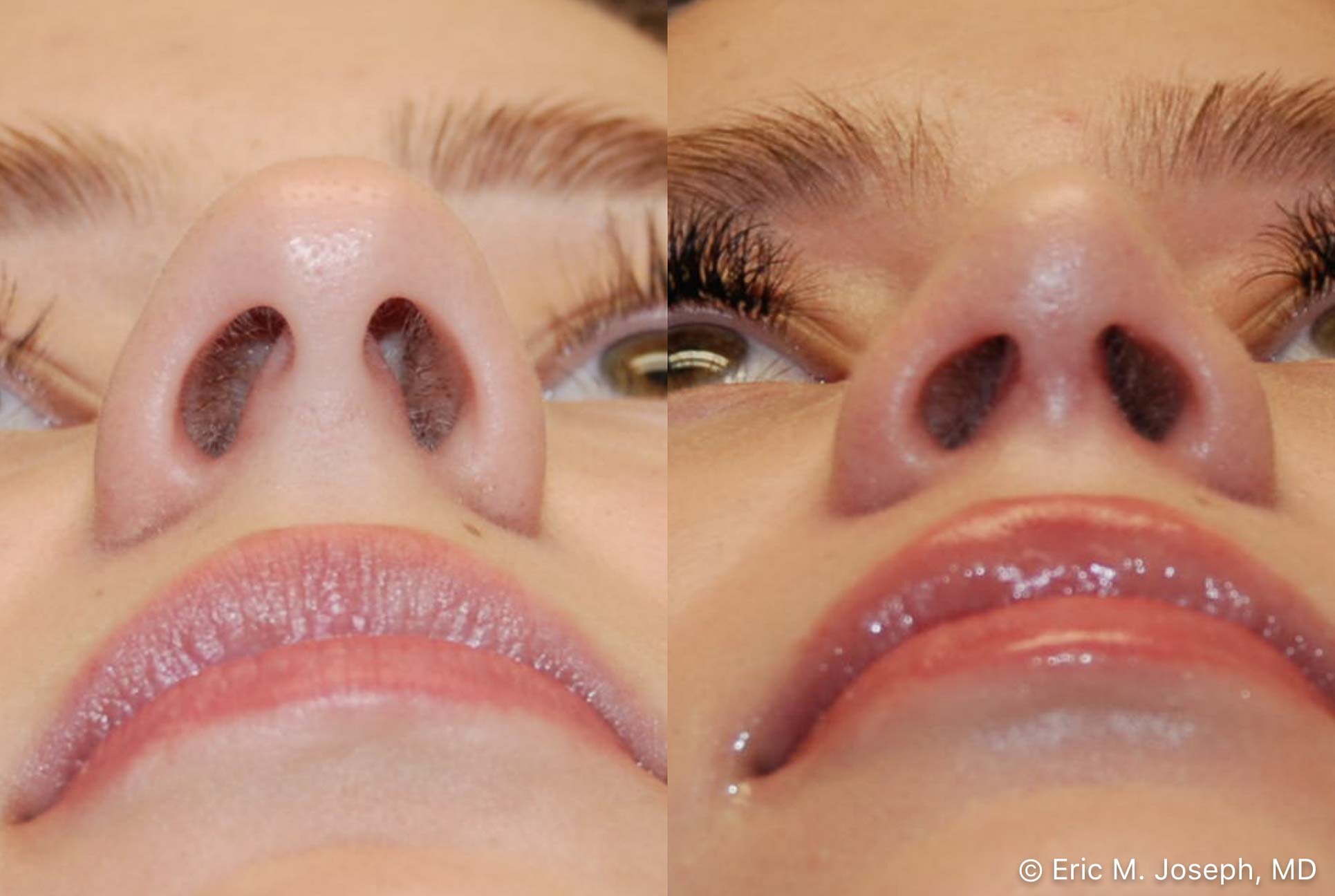 primary-rhinoplasty-nj-0904.jpg