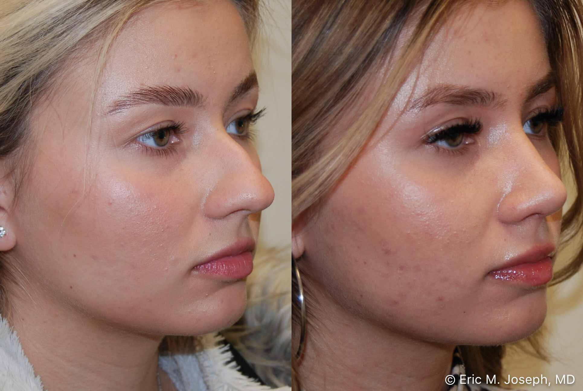 primary-rhinoplasty-nj-0905.jpg