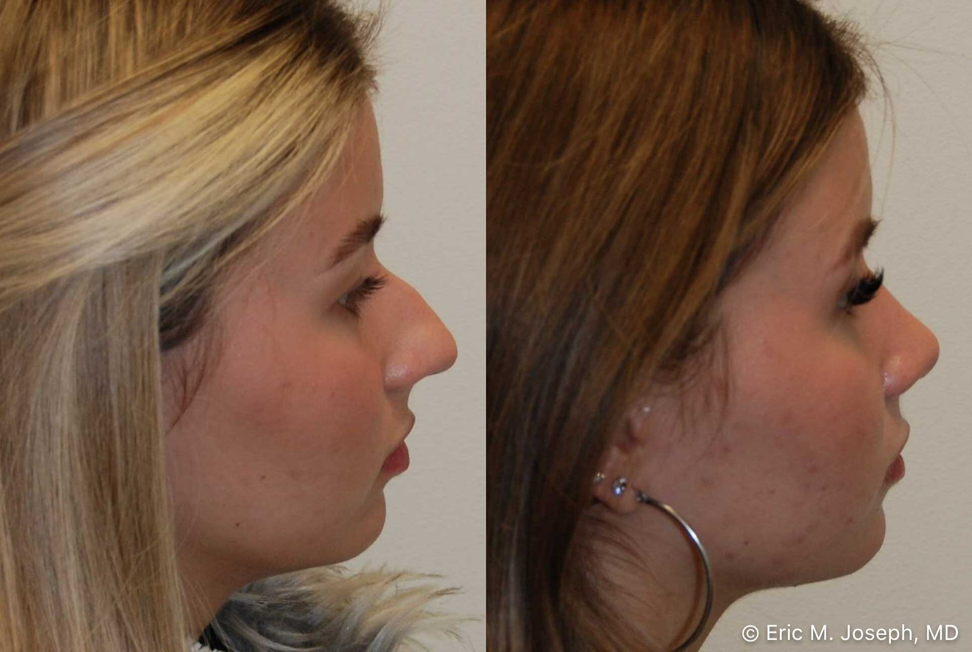 primary-rhinoplasty-nj-0908.jpg