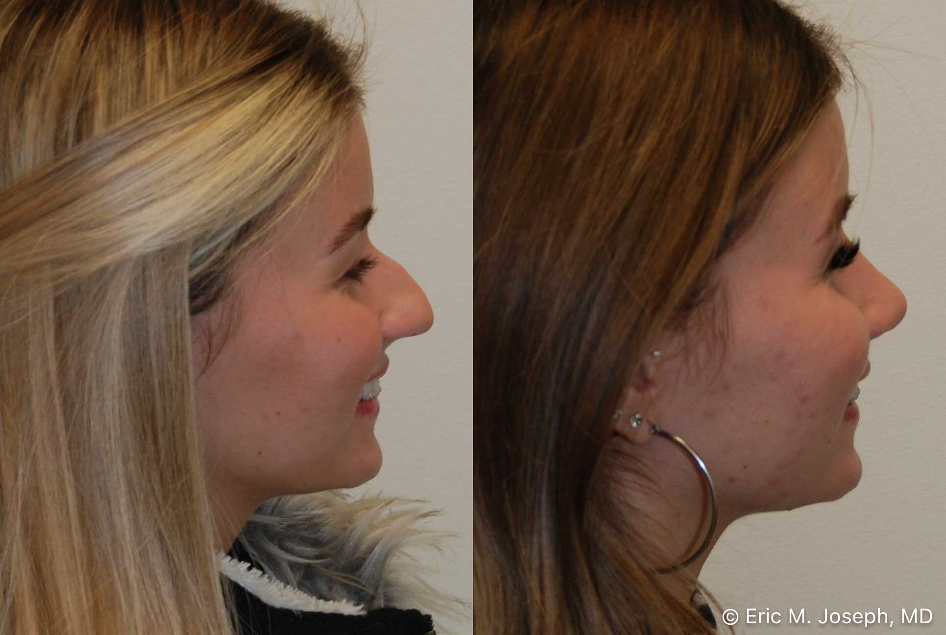 primary-rhinoplasty-nj-0909.jpg