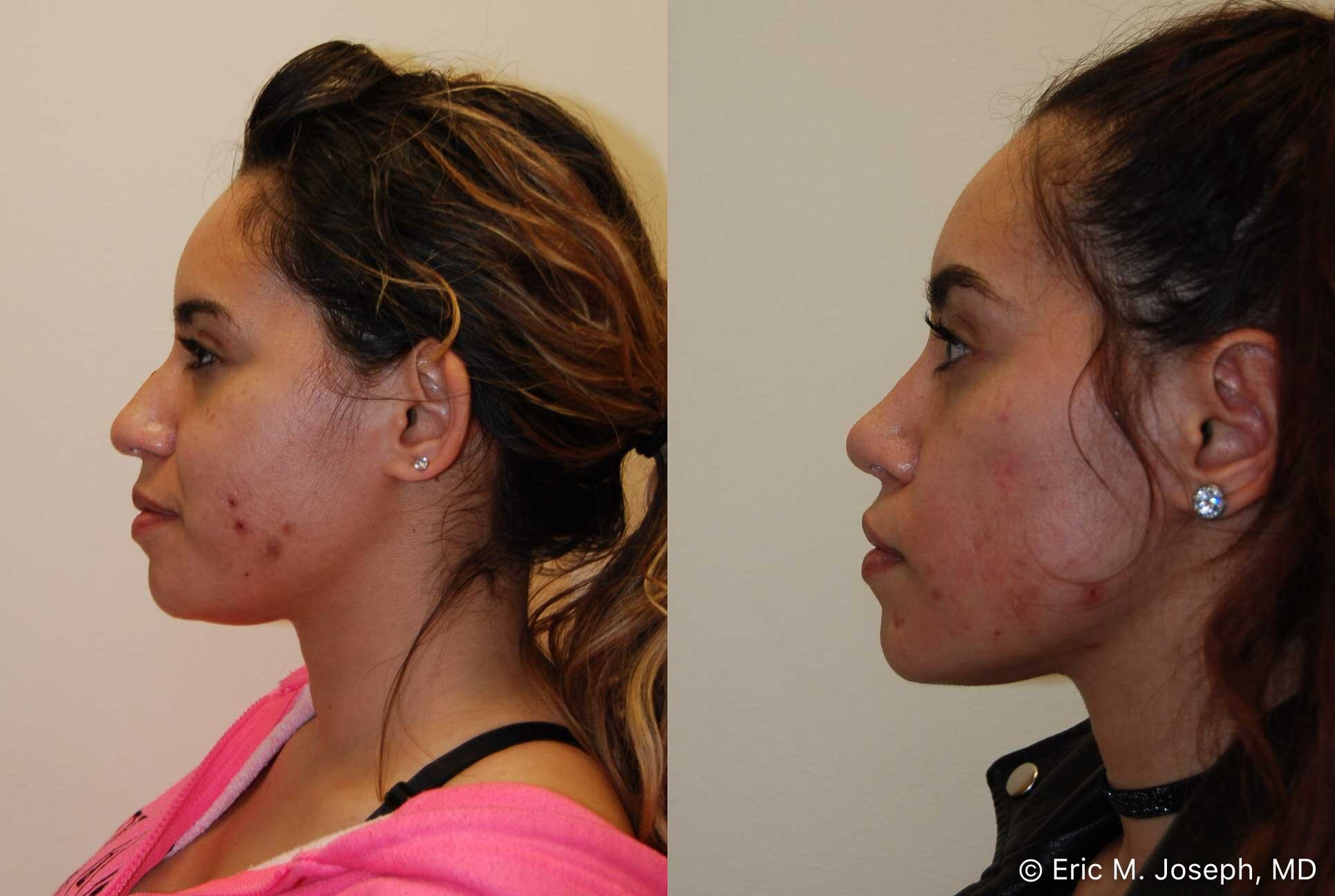 primary-rhinoplasty-nj-0924.jpg