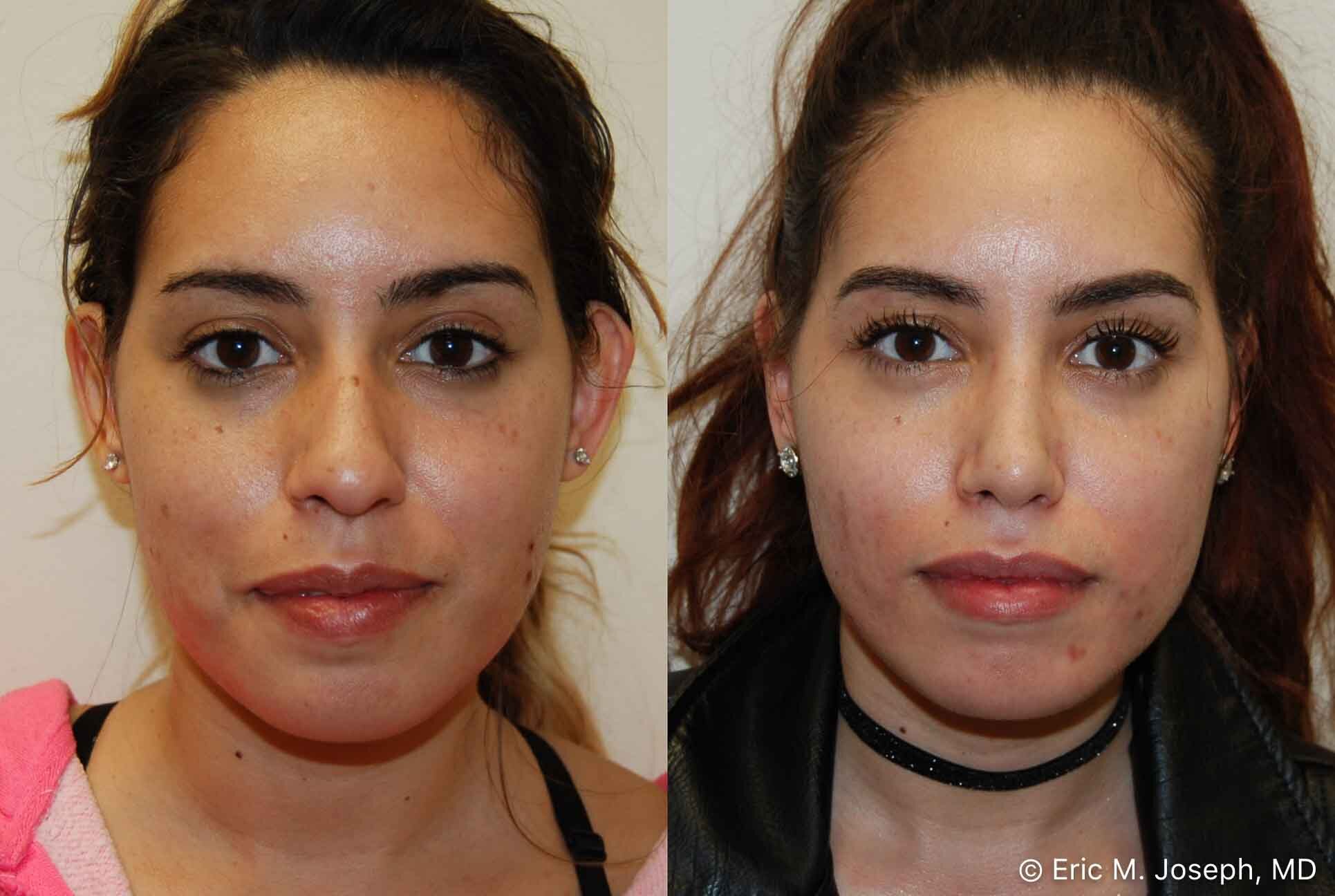 primary-rhinoplasty-nj-0926.jpg