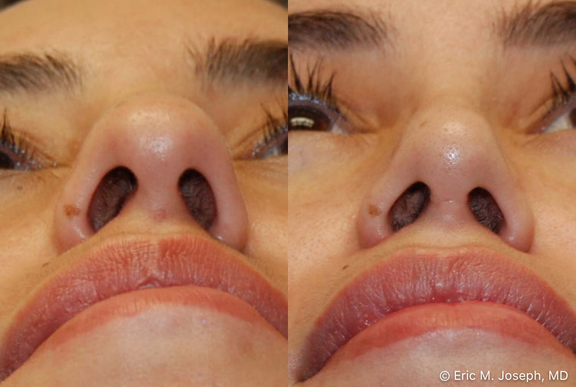 primary-rhinoplasty-nj-0927.jpg