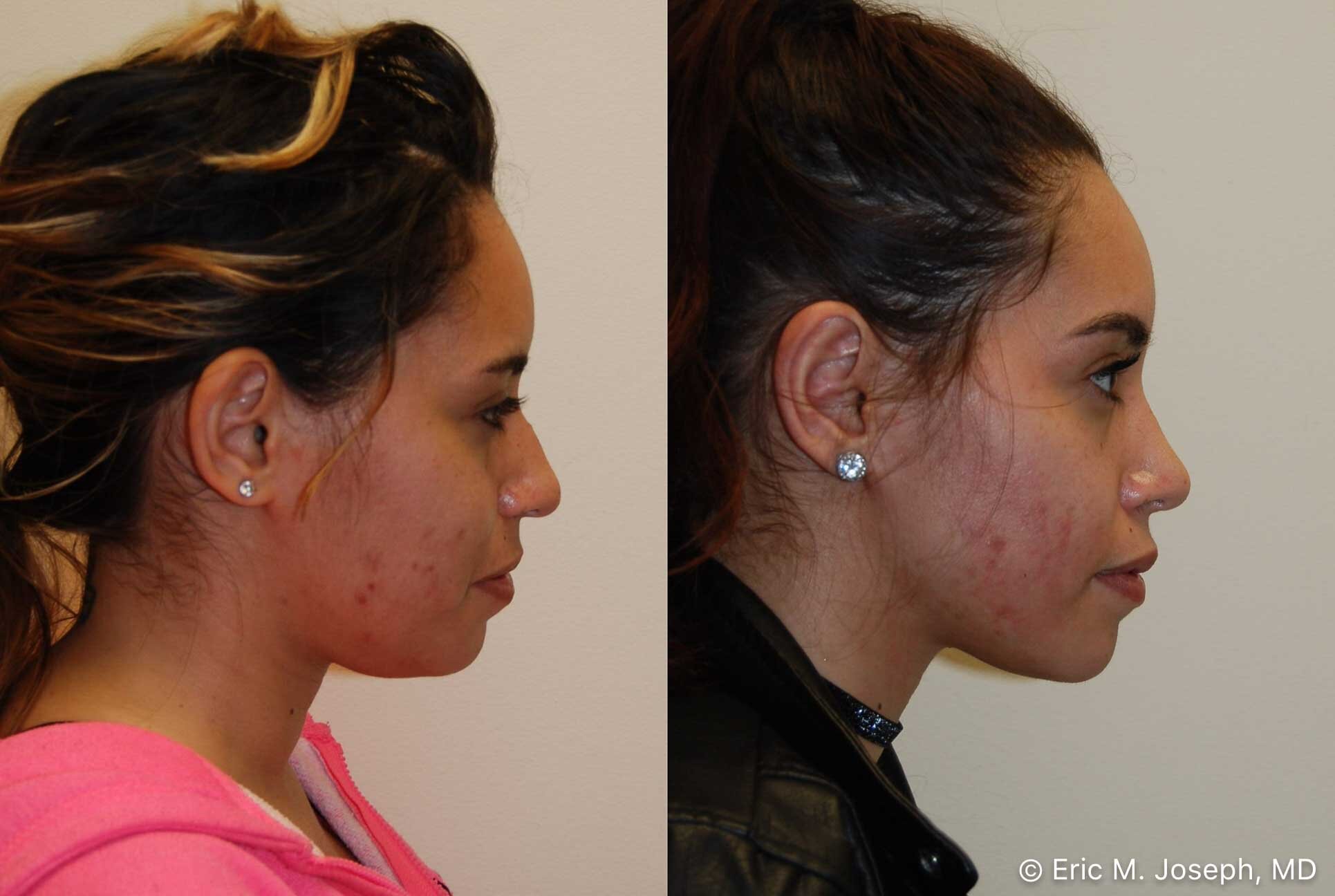 primary-rhinoplasty-nj-0929.jpg