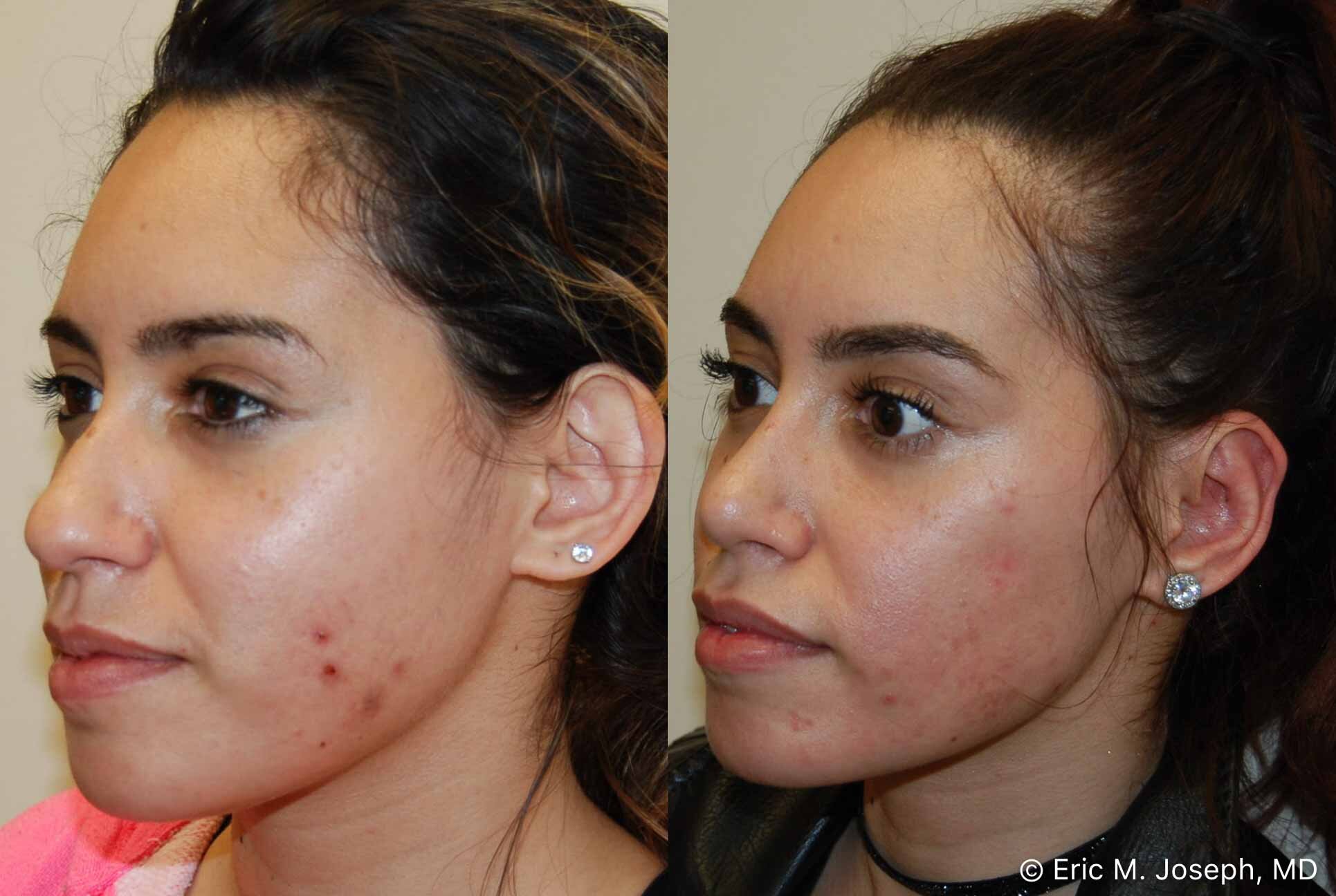 primary-rhinoplasty-nj-0930.jpg