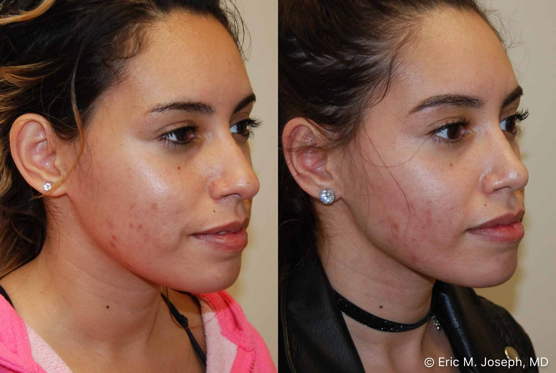 primary-rhinoplasty-nj-0931.jpg