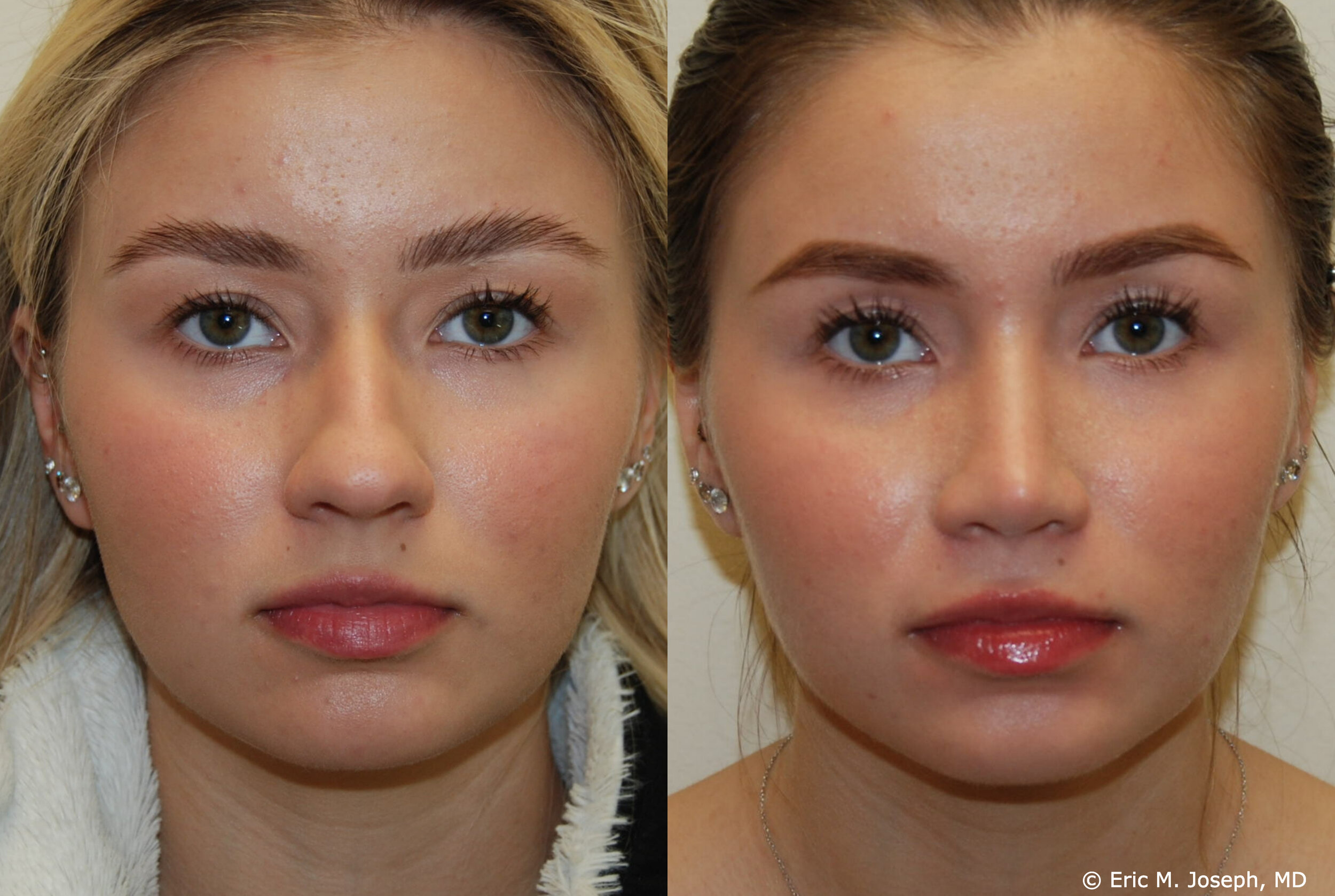 good nose job before and after