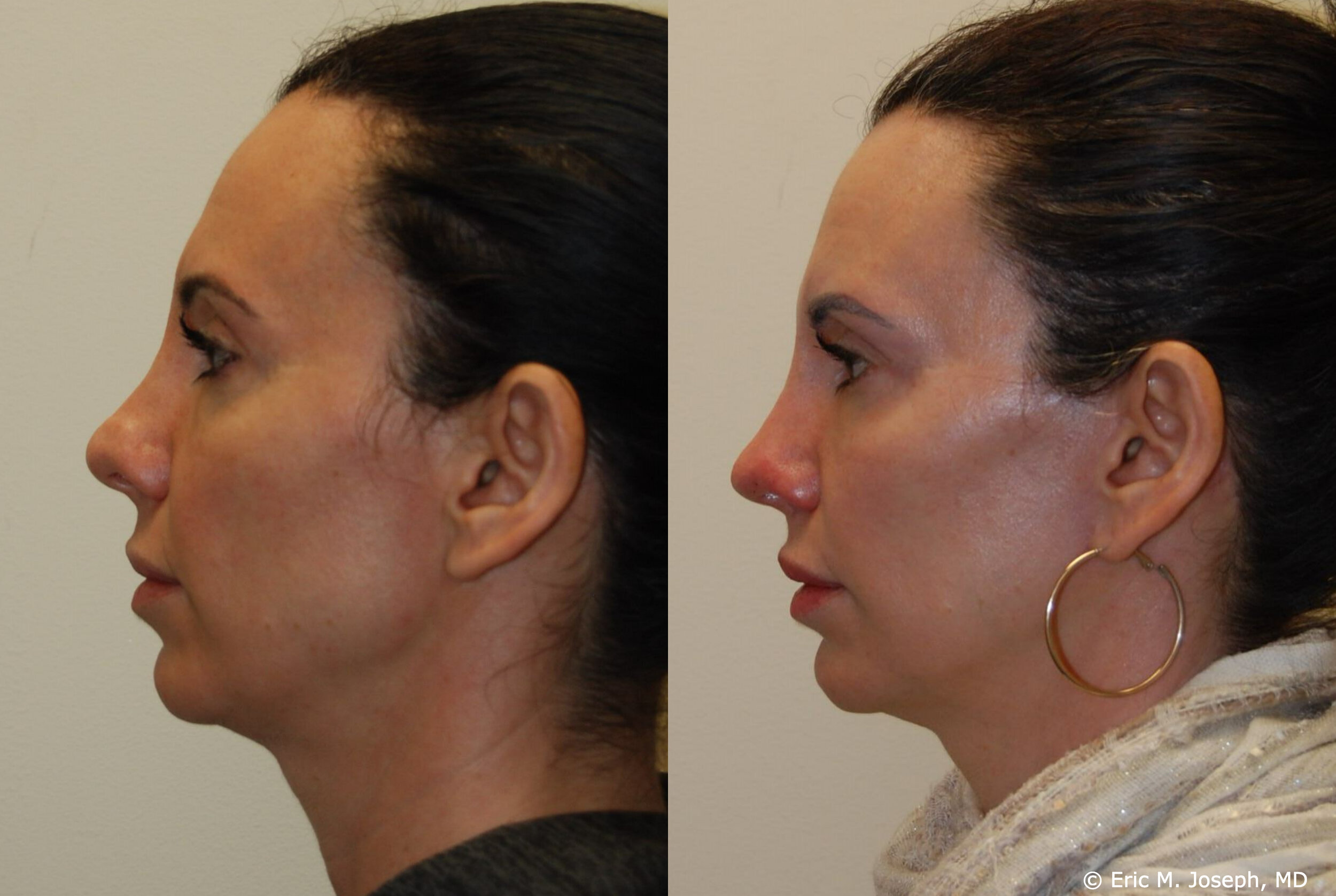 revision-otoplasty-rhinoplasty-nj-0938.jpg