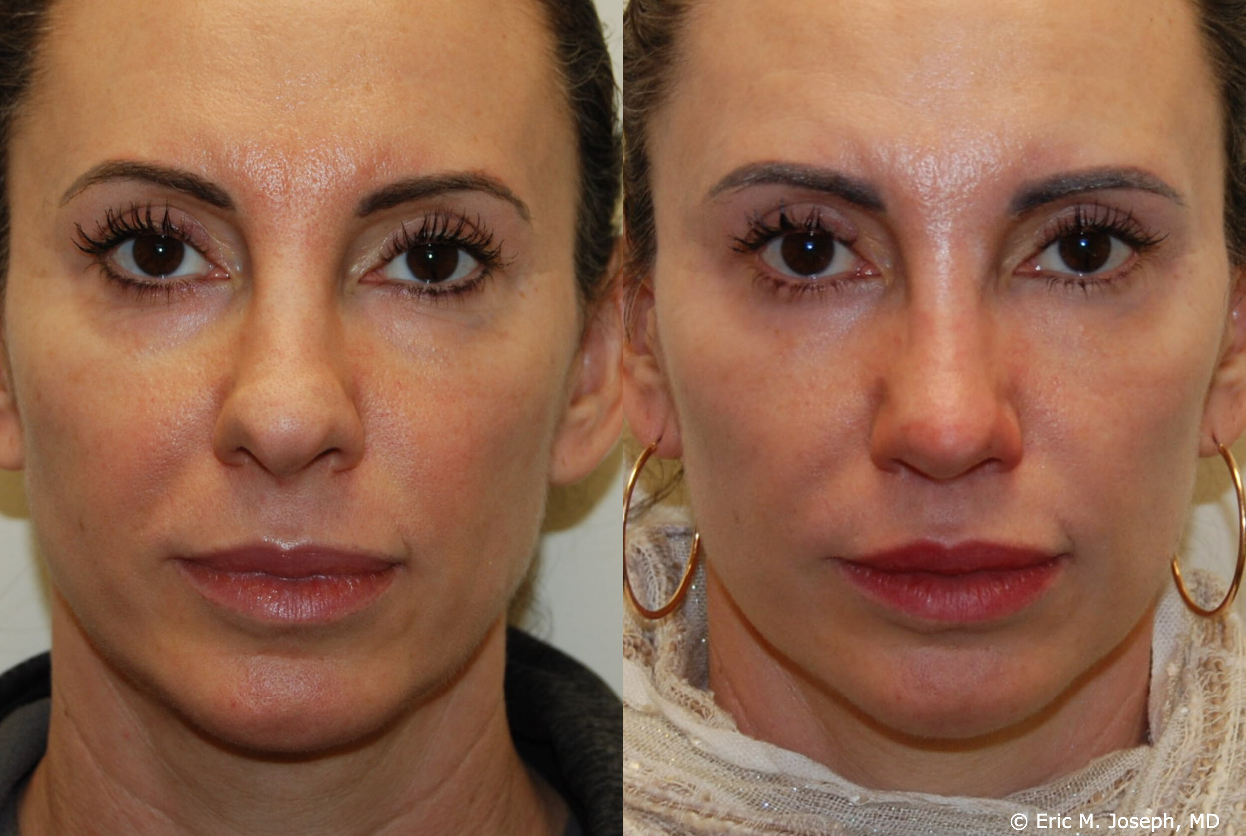 revision-otoplasty-rhinoplasty-nj-0936.jpg