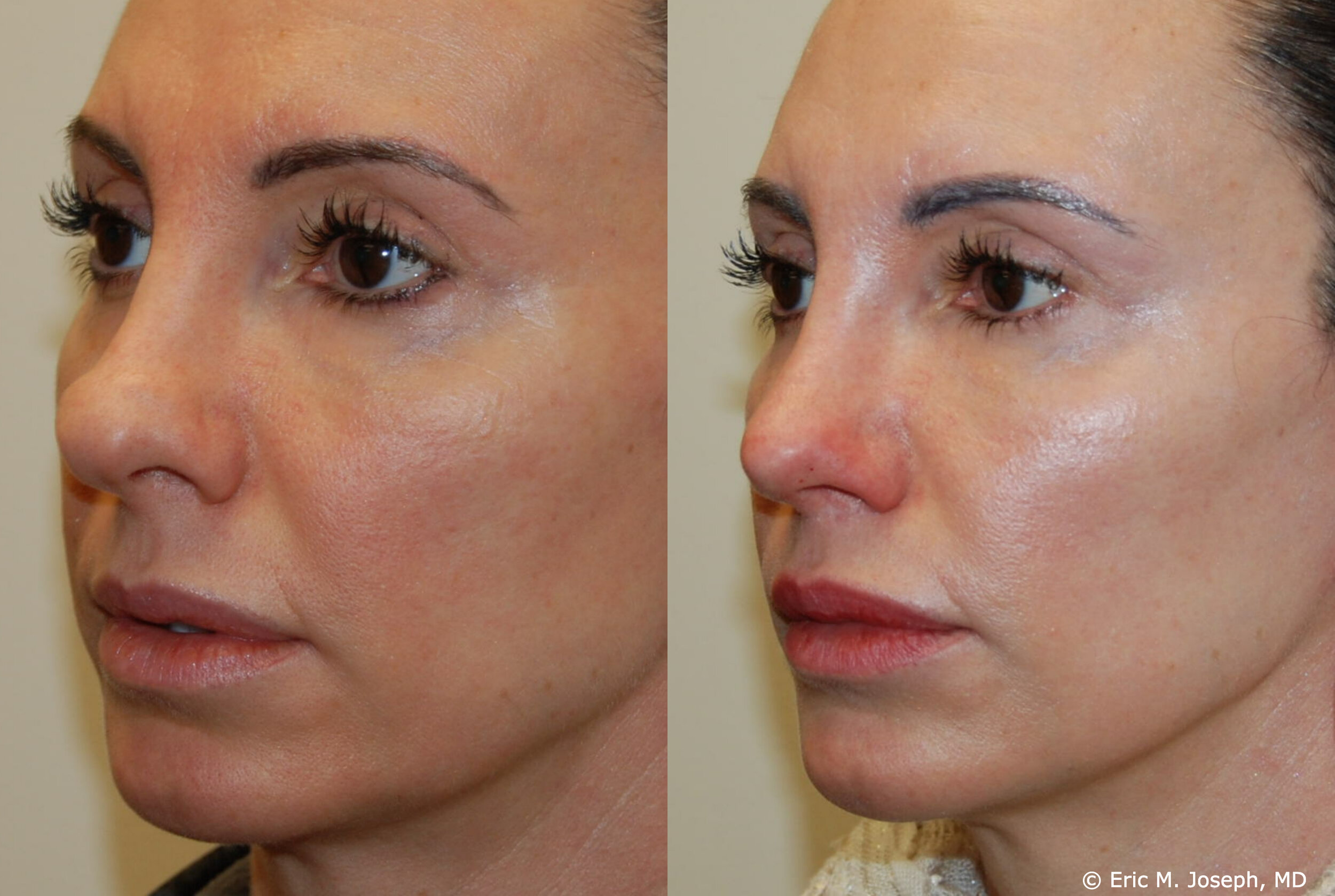 revision-otoplasty-rhinoplasty-nj-0935.jpg