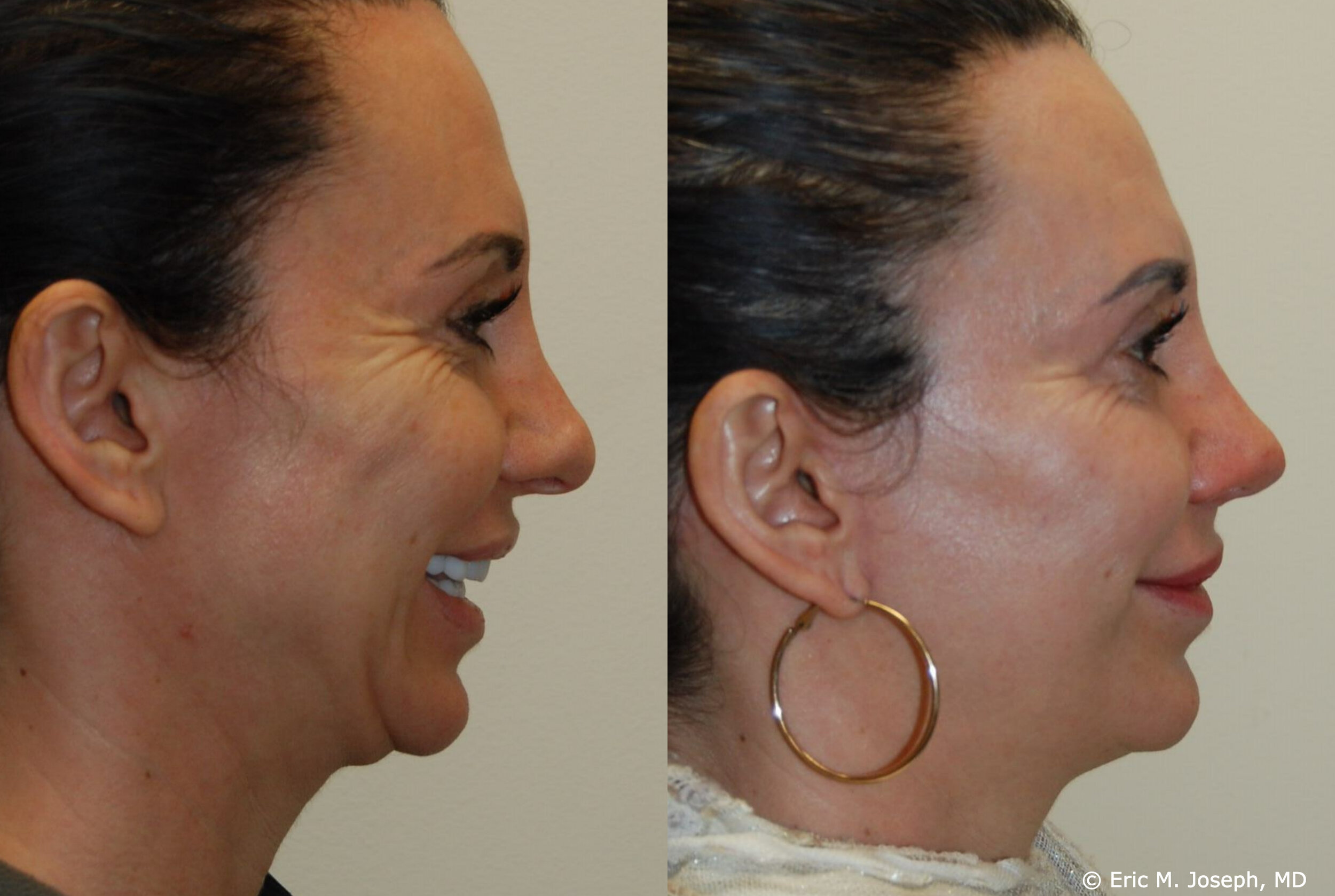 revision-otoplasty-rhinoplasty-nj-0934.jpg