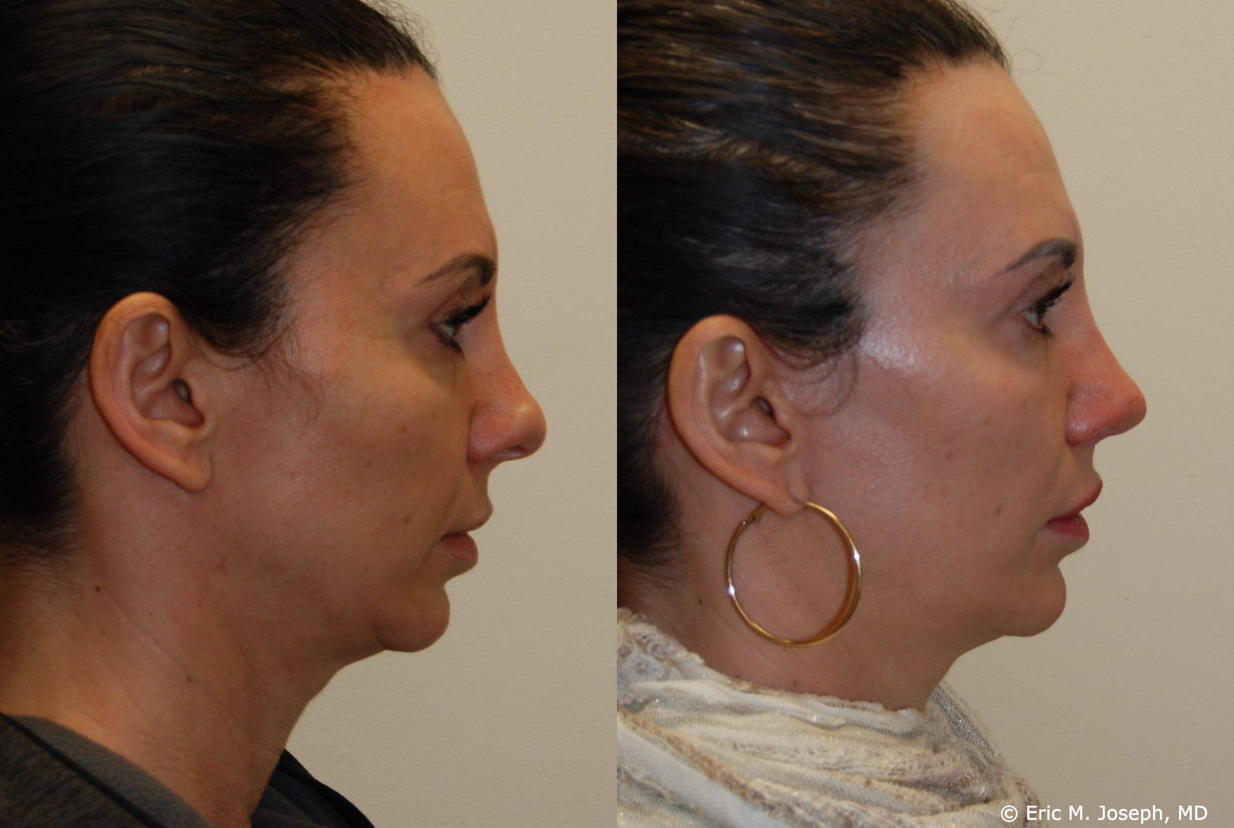 revision-otoplasty-rhinoplasty-nj-0933.jpg