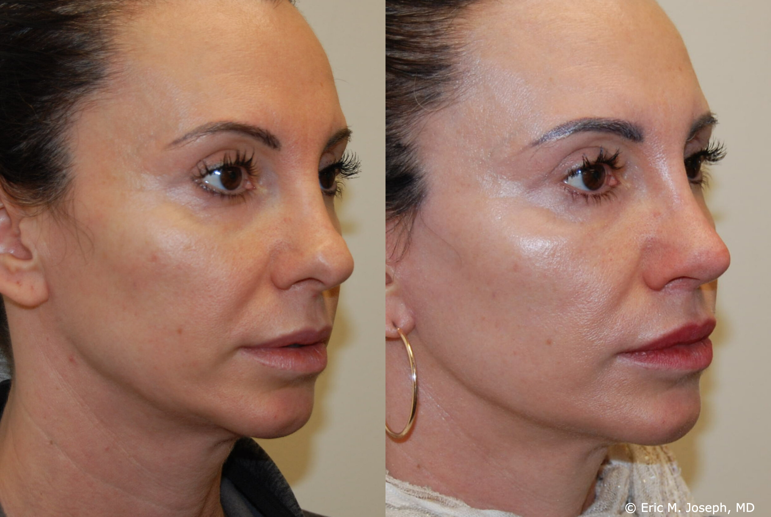 revision-otoplasty-rhinoplasty-nj-0932.jpg