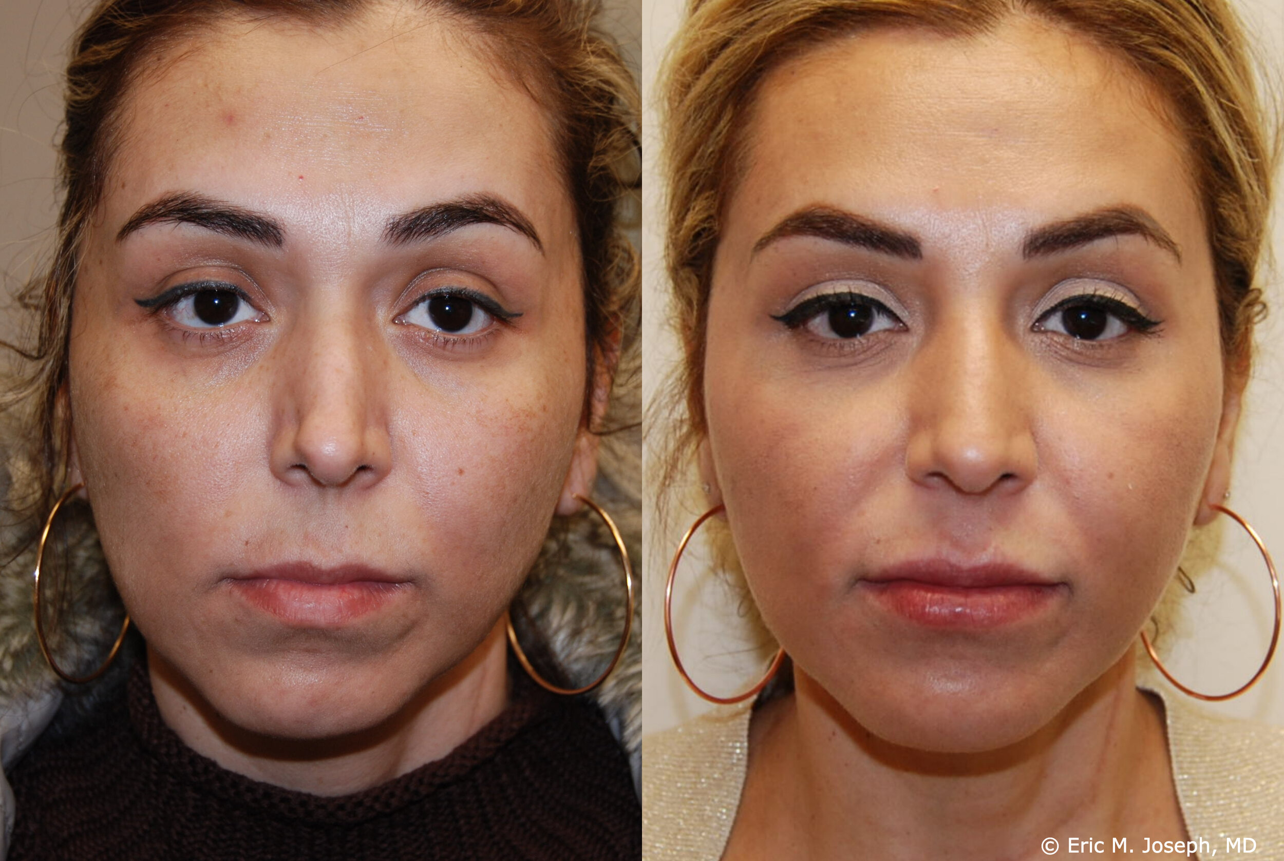 Lip Augmentation Before and After Pictures Case 242 - Naples, FL - Kent V Hasen, MD: Aesthetic Plastic Surgery & Med Spa of Naples
