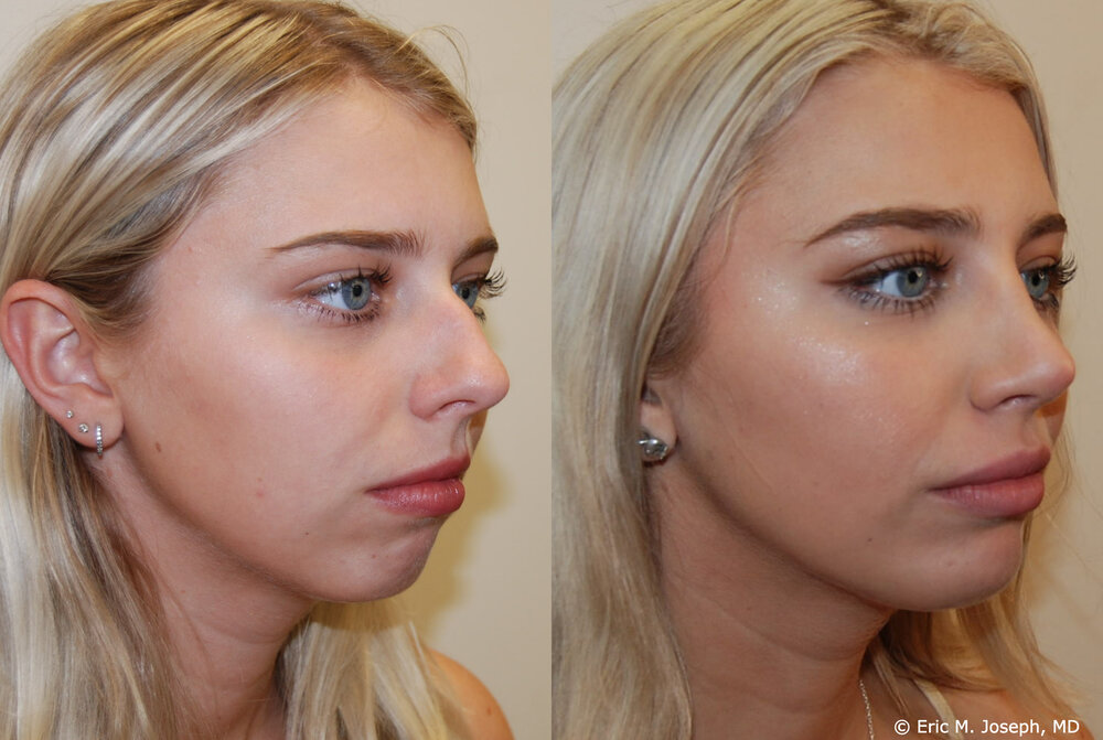good nose job before and after