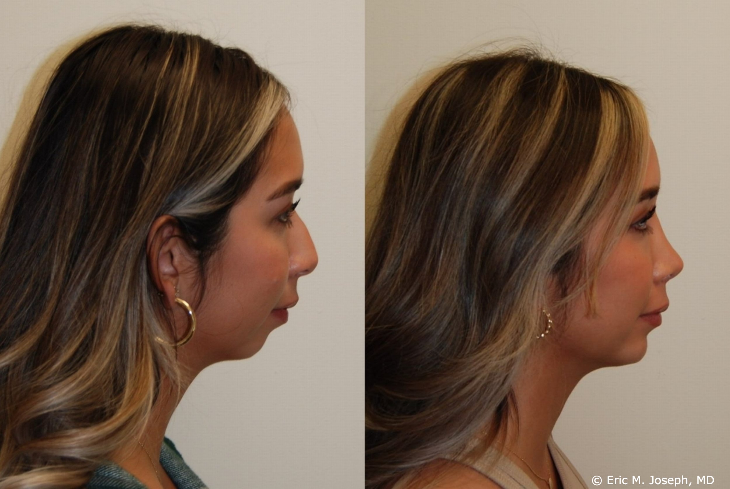 primary-rhinoplasty-nj-1070.jpg