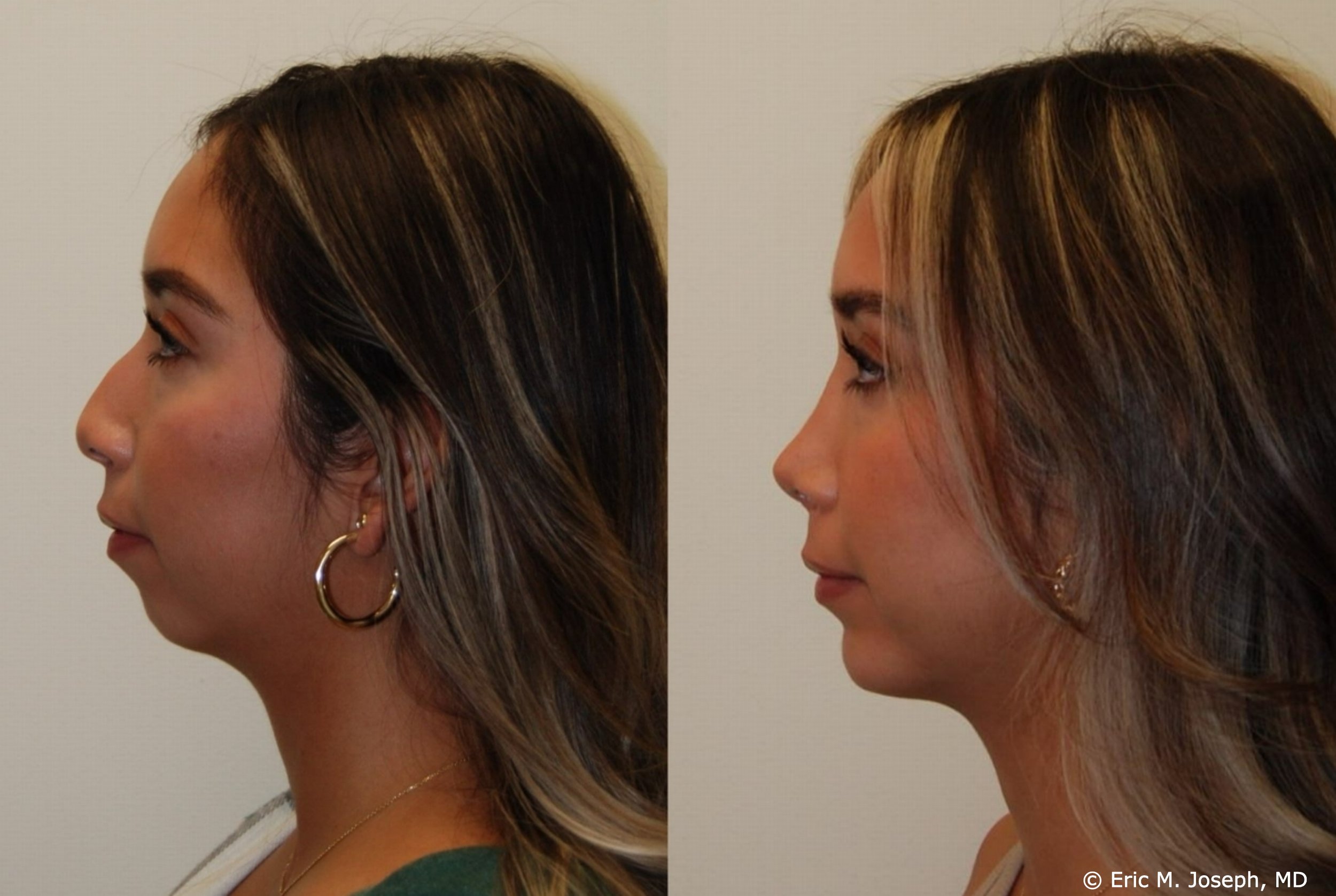 primary-rhinoplasty-nj-1069.jpg