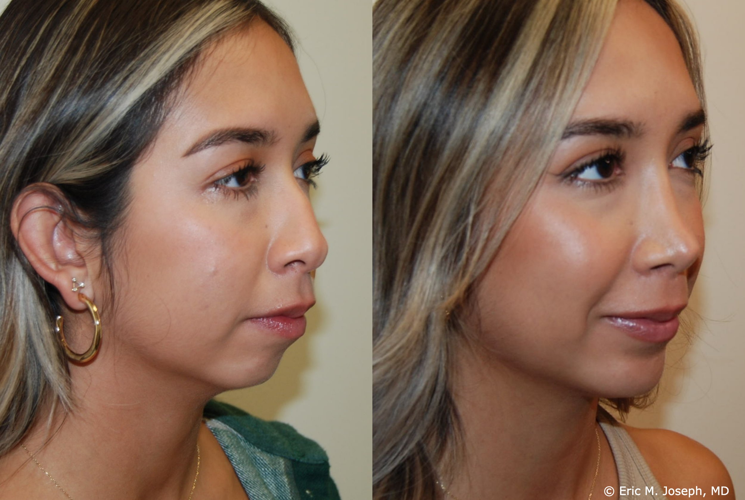 primary-rhinoplasty-nj-1067.jpg