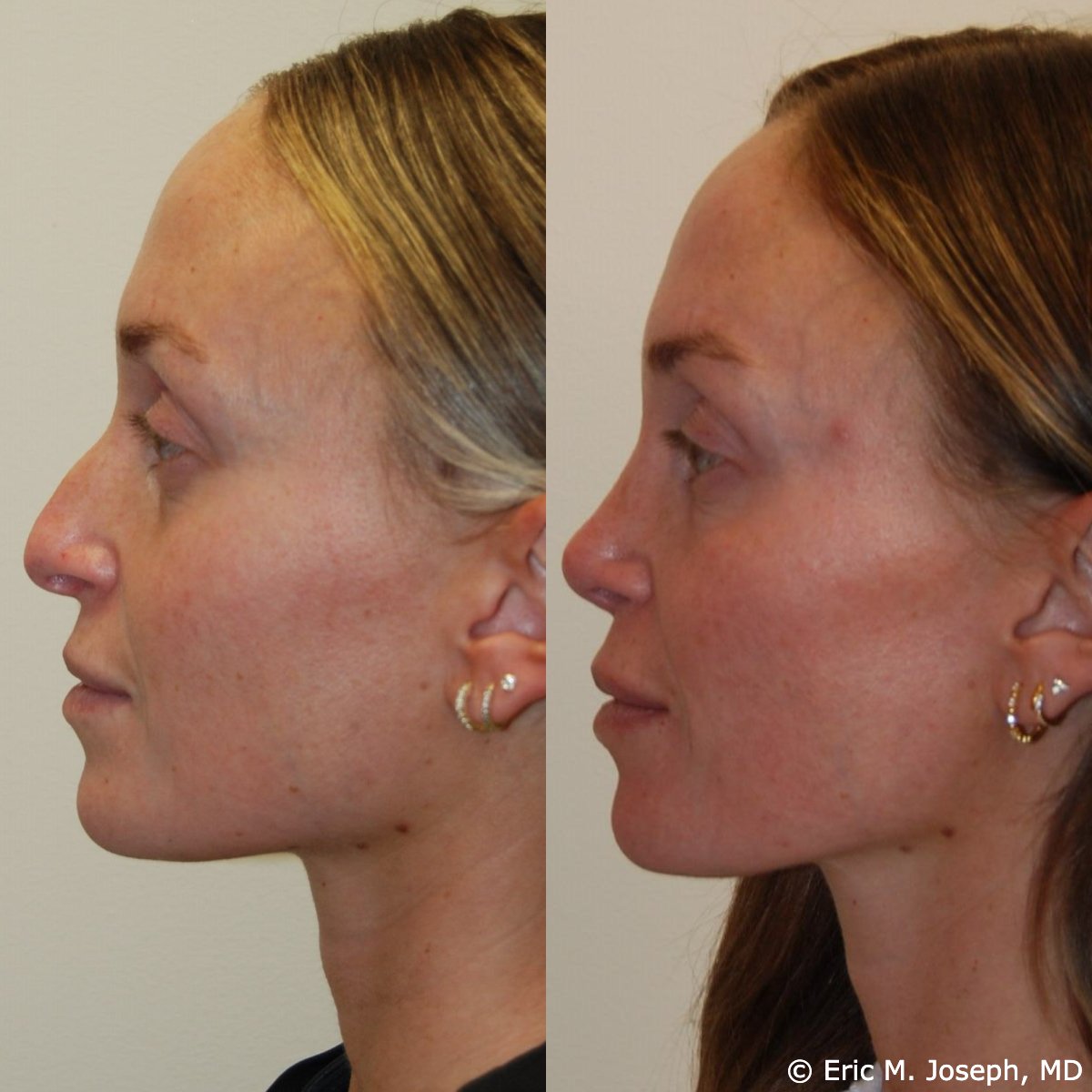 primary-rhinoplasty-nj-1134.jpg