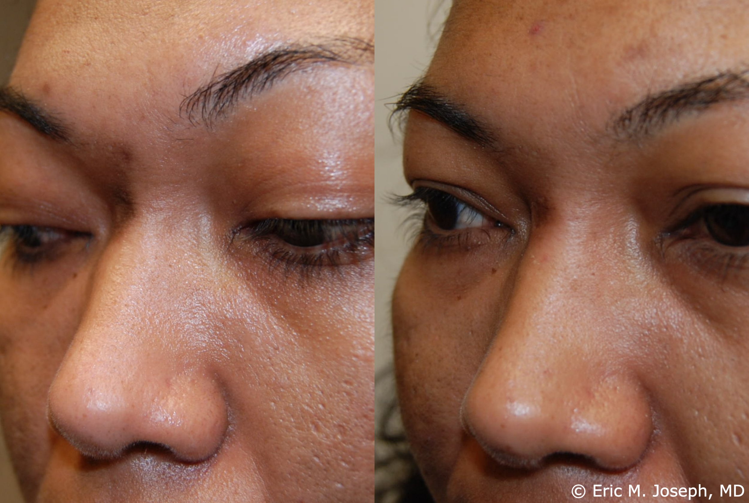 acne-scar-correction-nj-permanent-0027.jpg