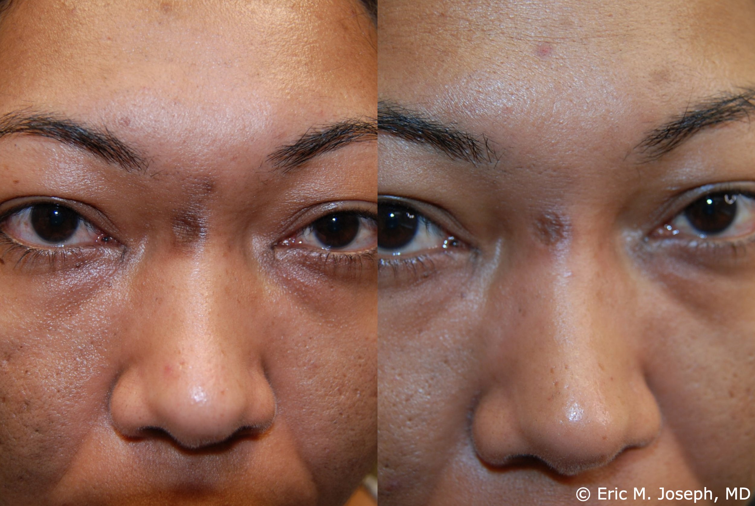 acne-scar-correction-nj-permanent-0026.jpg