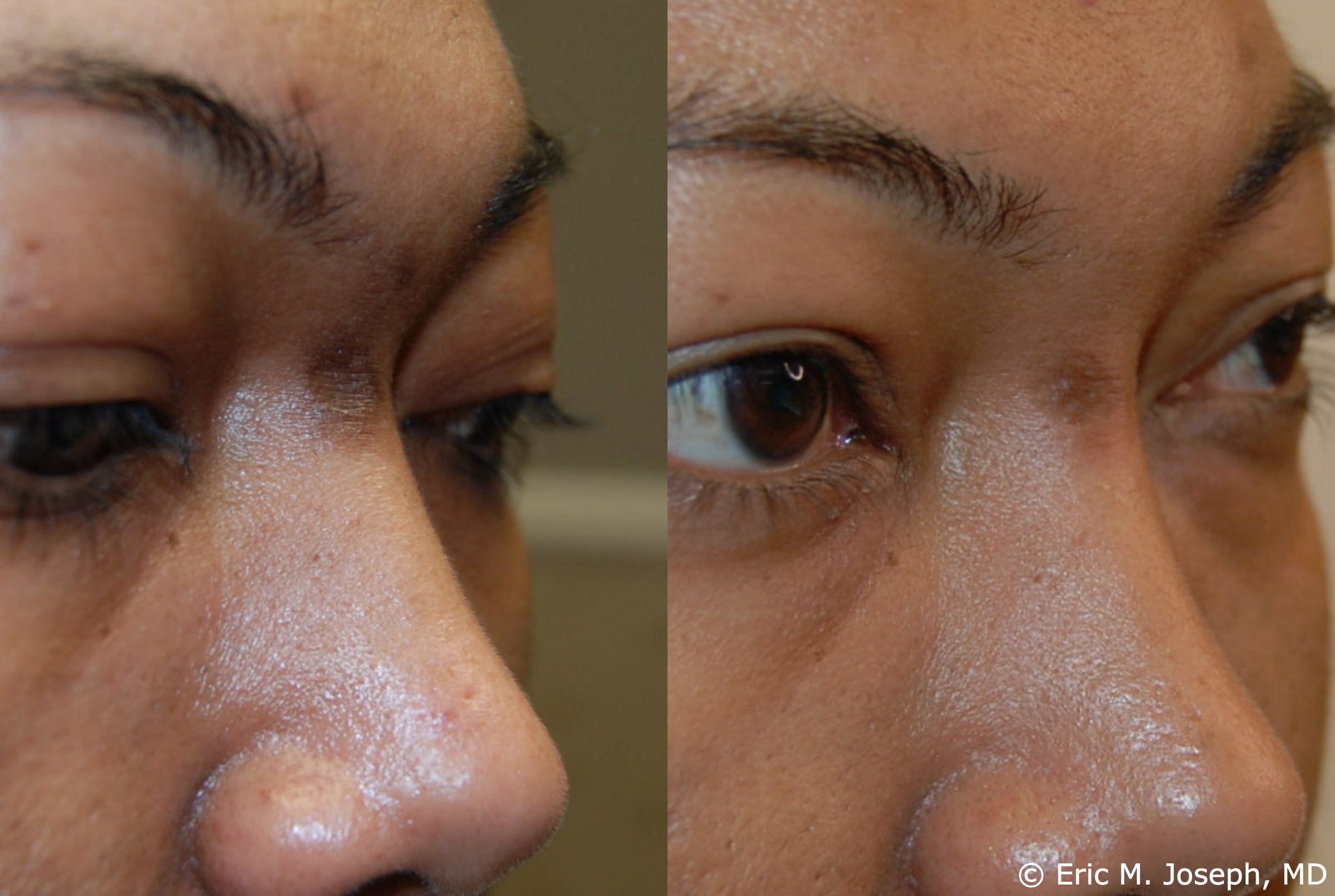 acne-scar-correction-nj-permanent-0025.jpg