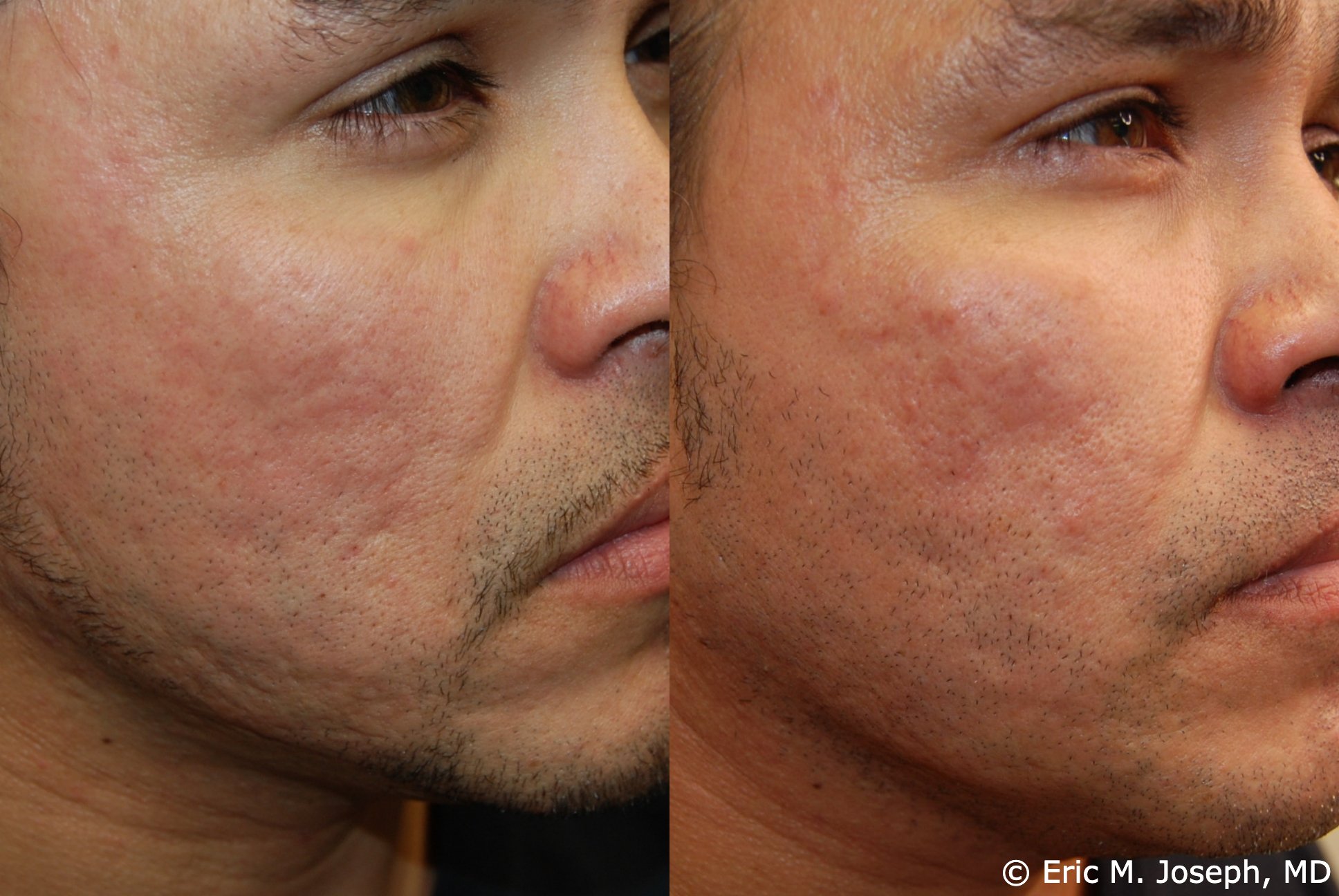 acne-scar-correction-nj-permanent-0029.jpg