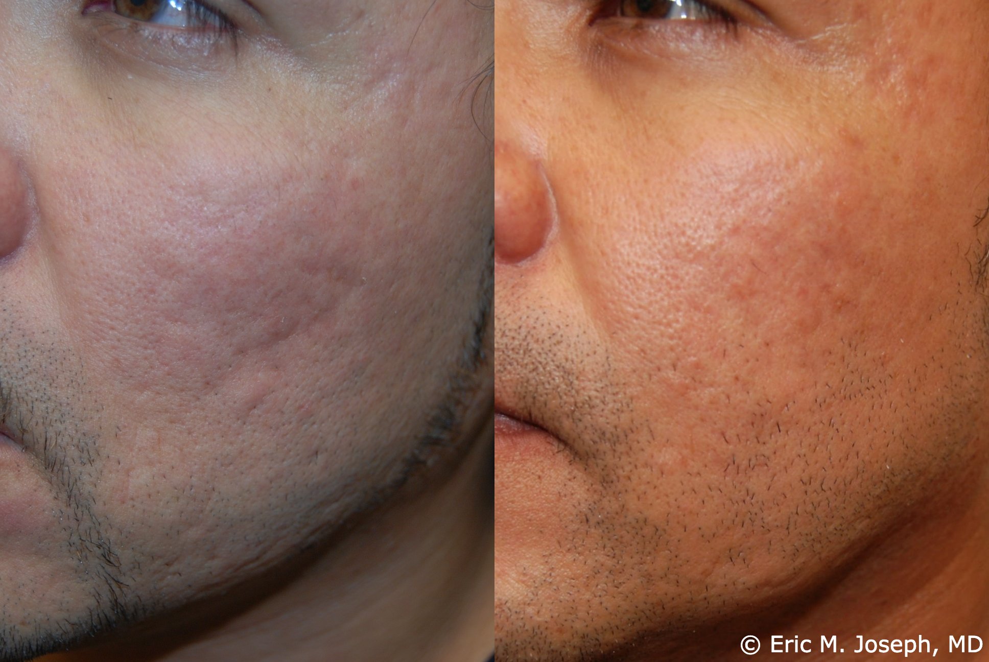 acne-scar-correction-nj-permanent-0028.jpg