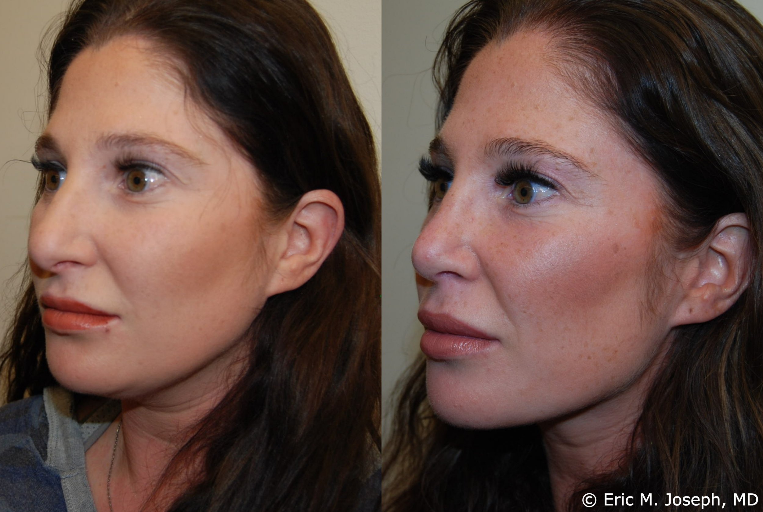 primary-rhinoplasty-nj-1192.jpg