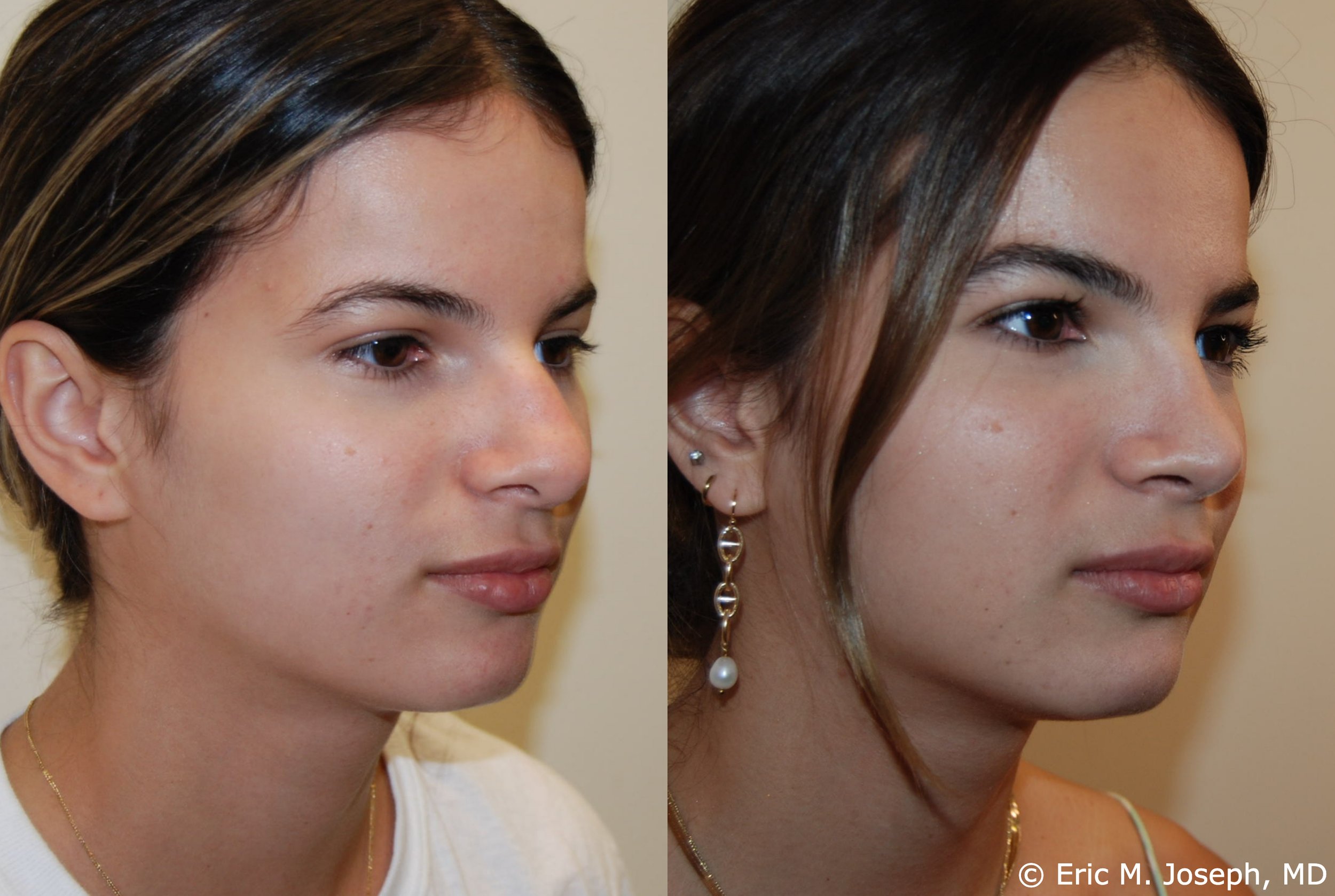 primary-rhinoplasty-nj-1201.jpg