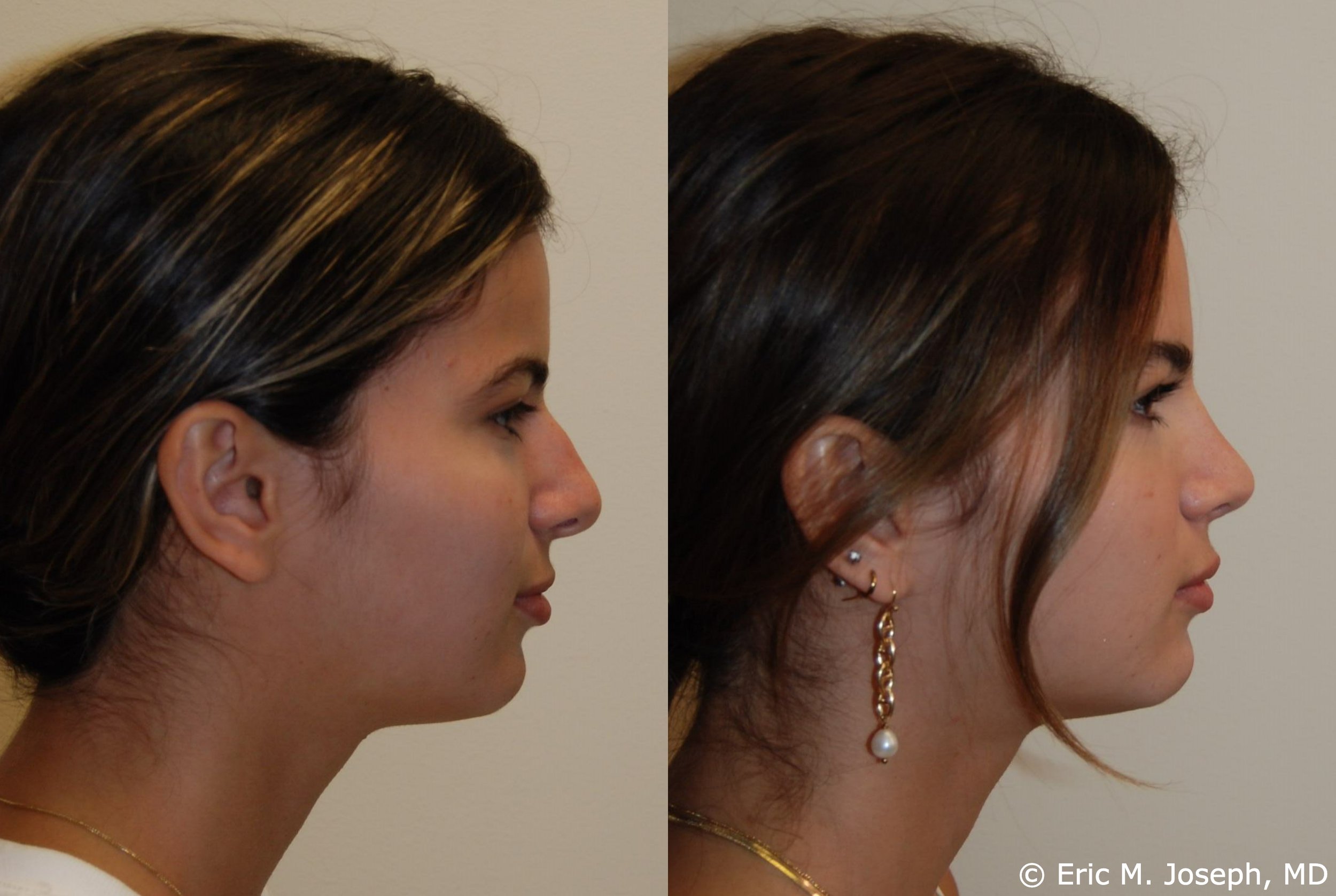 primary-rhinoplasty-nj-1198.jpg