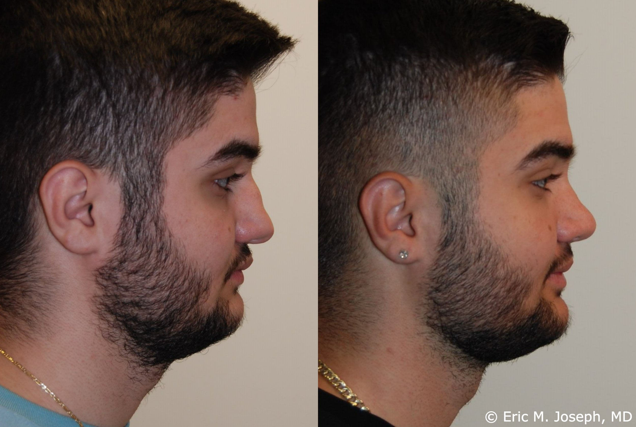 primary-rhinoplasty-nj-1211.jpg