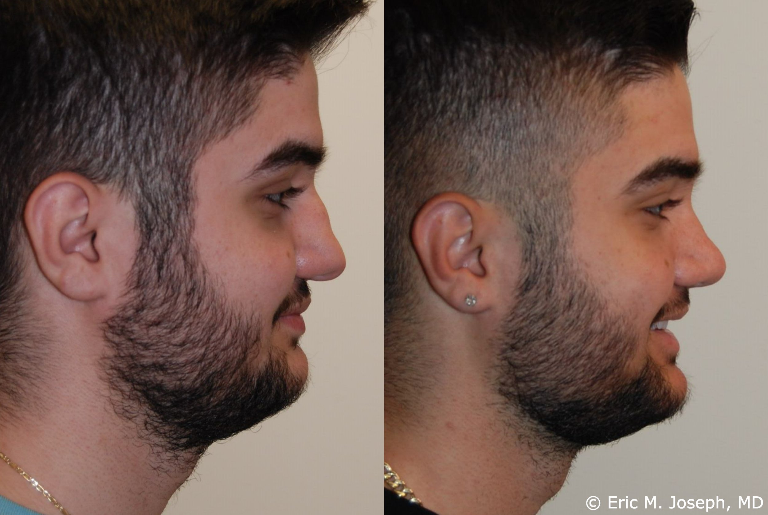 primary-rhinoplasty-nj-1212.jpg