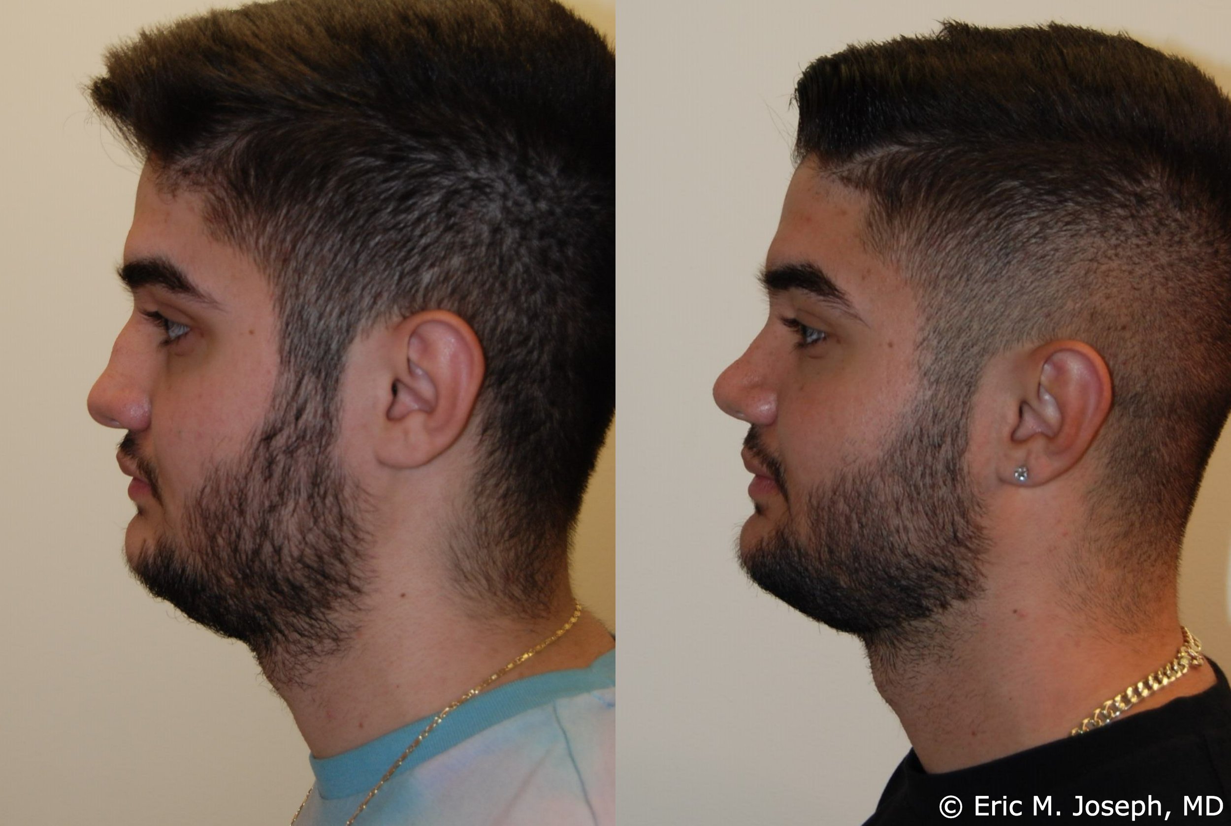 primary-rhinoplasty-nj-1210.jpg