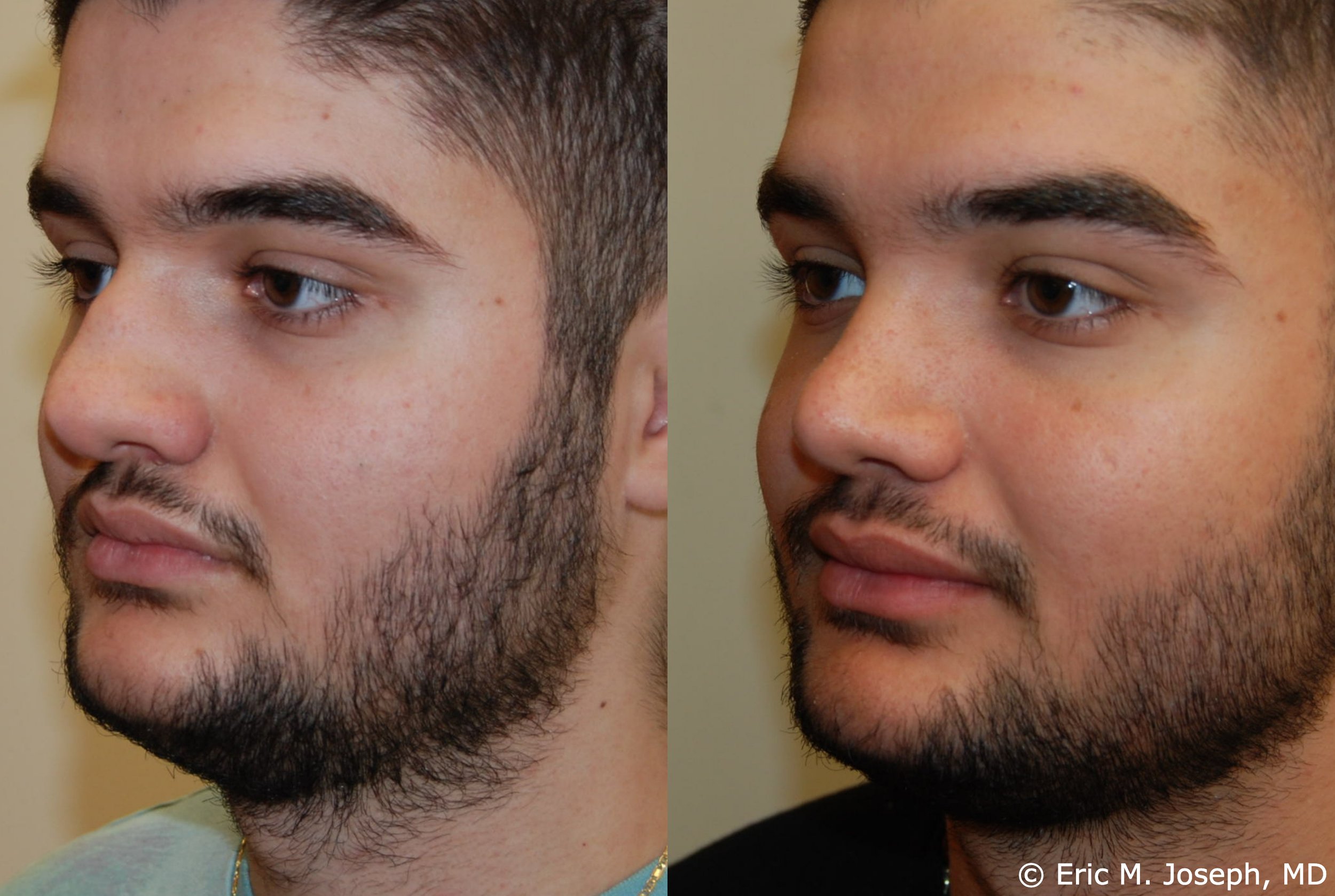 primary-rhinoplasty-nj-1209.jpg