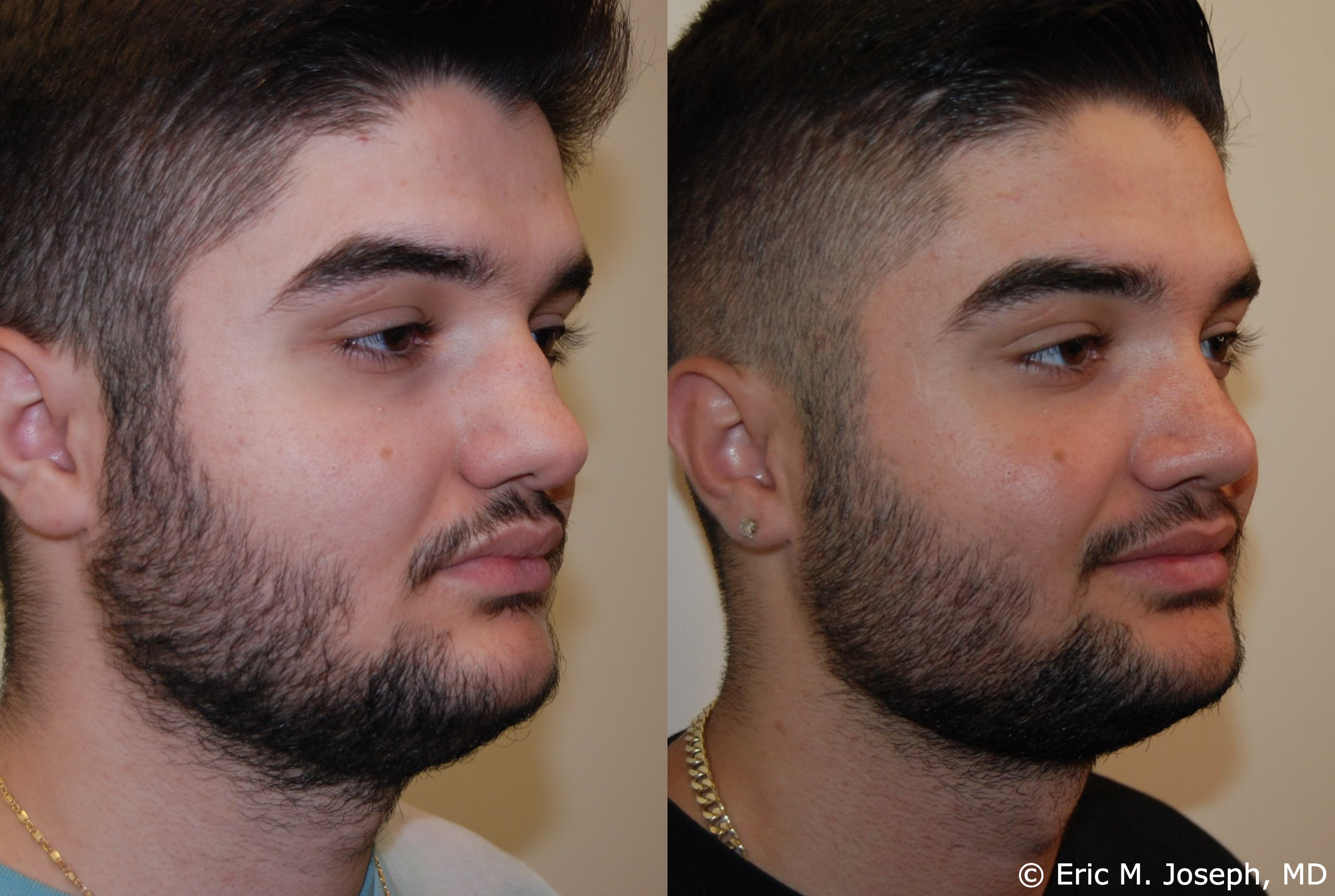 primary-rhinoplasty-nj-1208.jpg