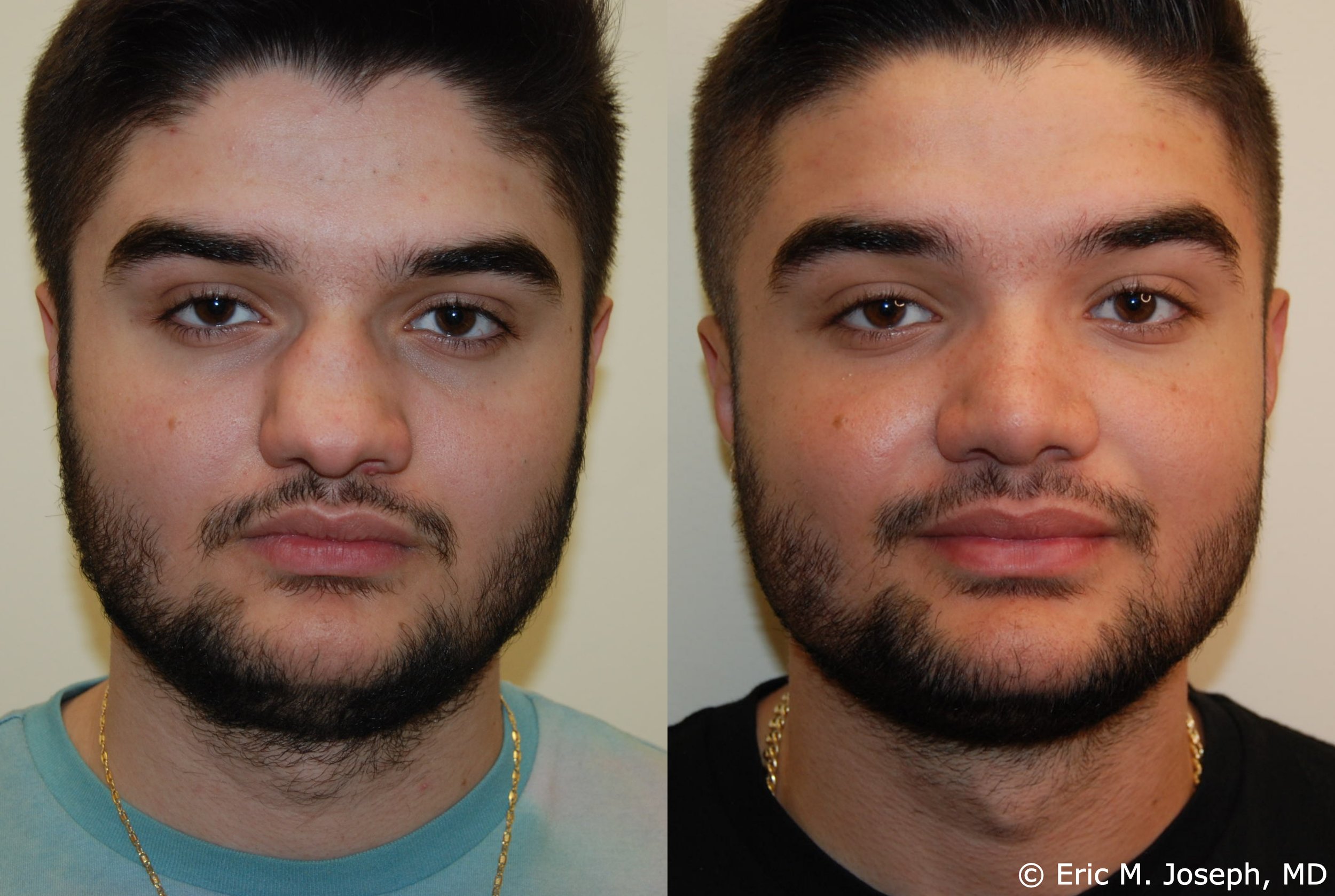 primary-rhinoplasty-nj-1205.jpg