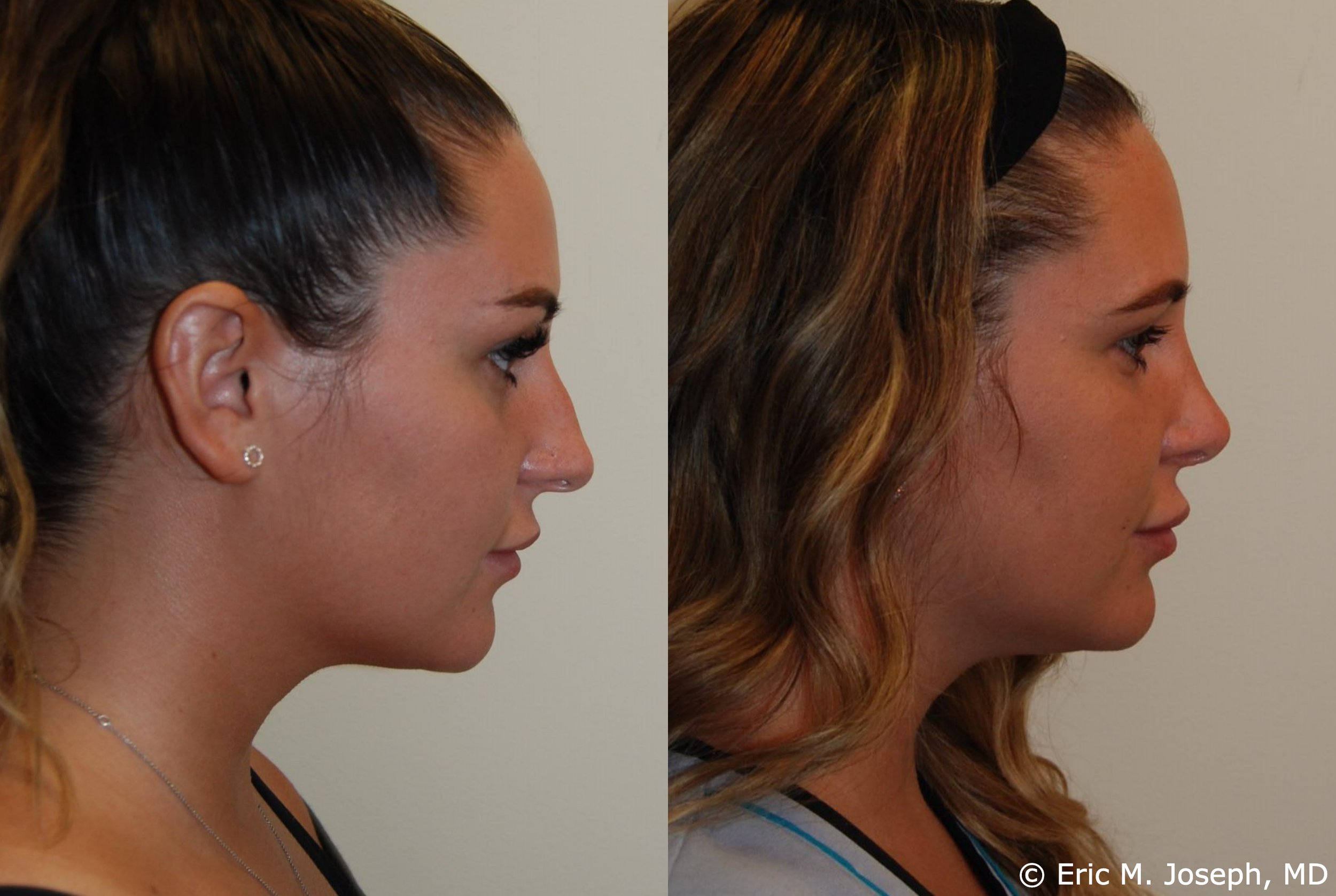 Eric M Joseph Md Rhinoplasty Before And After Profile Bump And