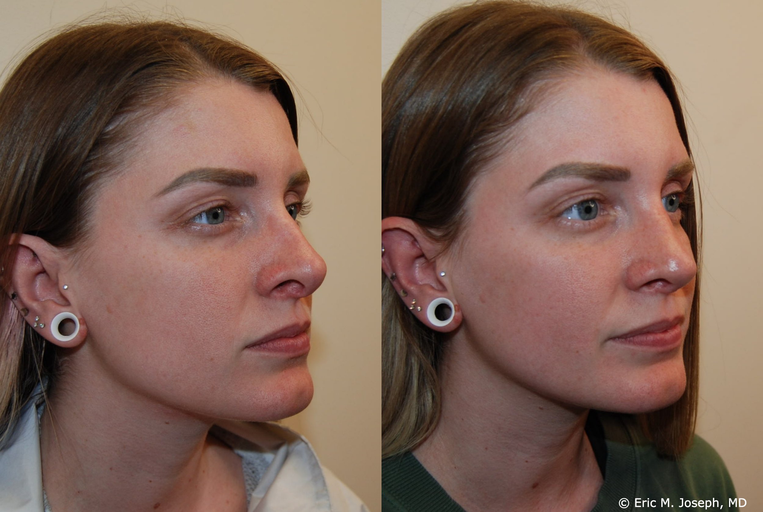 revision-rhinoplasty-nj-0971.jpg