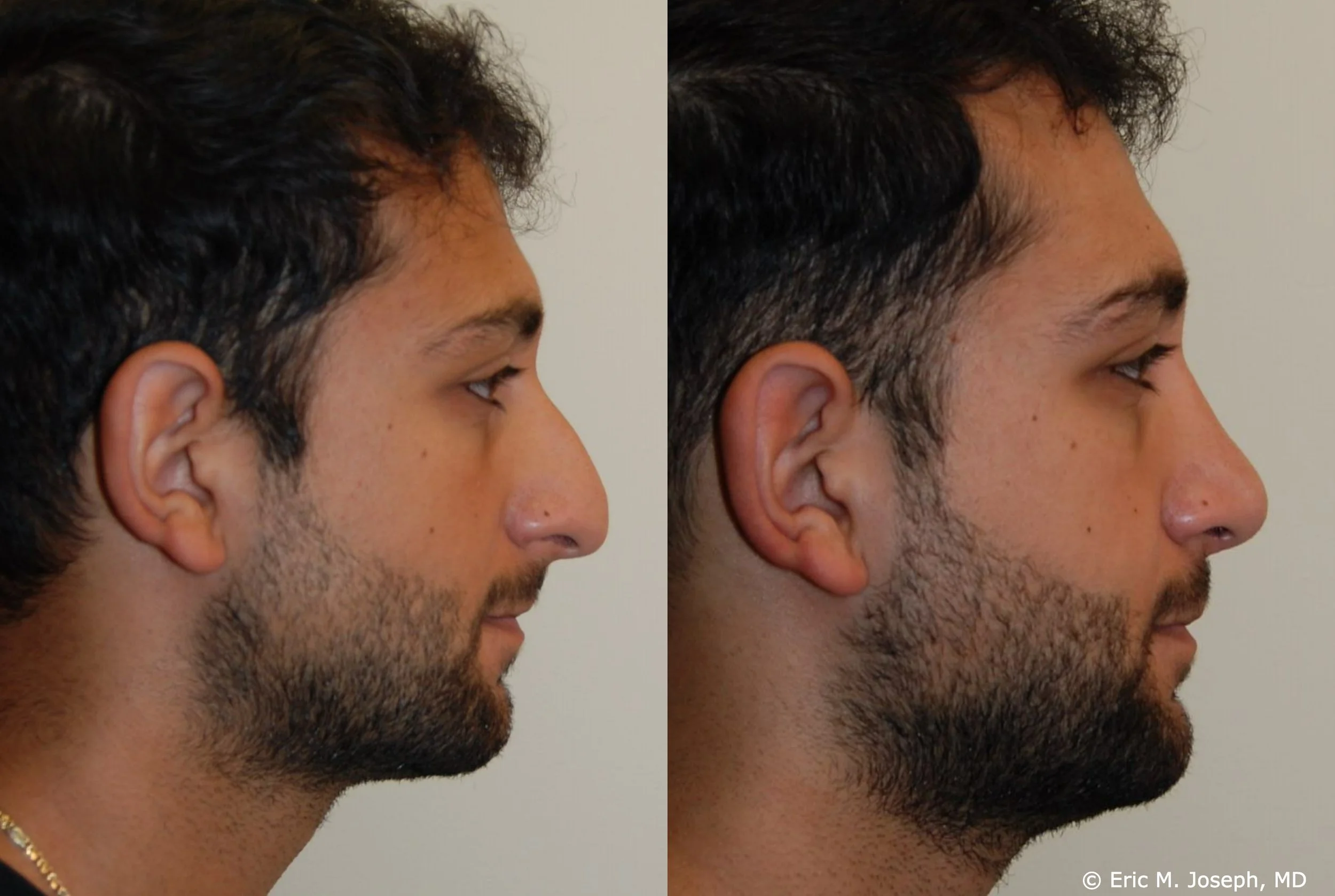 Nose Job Before And After Men Male Rhinoplasty Before And After Nose Job Before And After Men Male Rhinoplasty Before And After