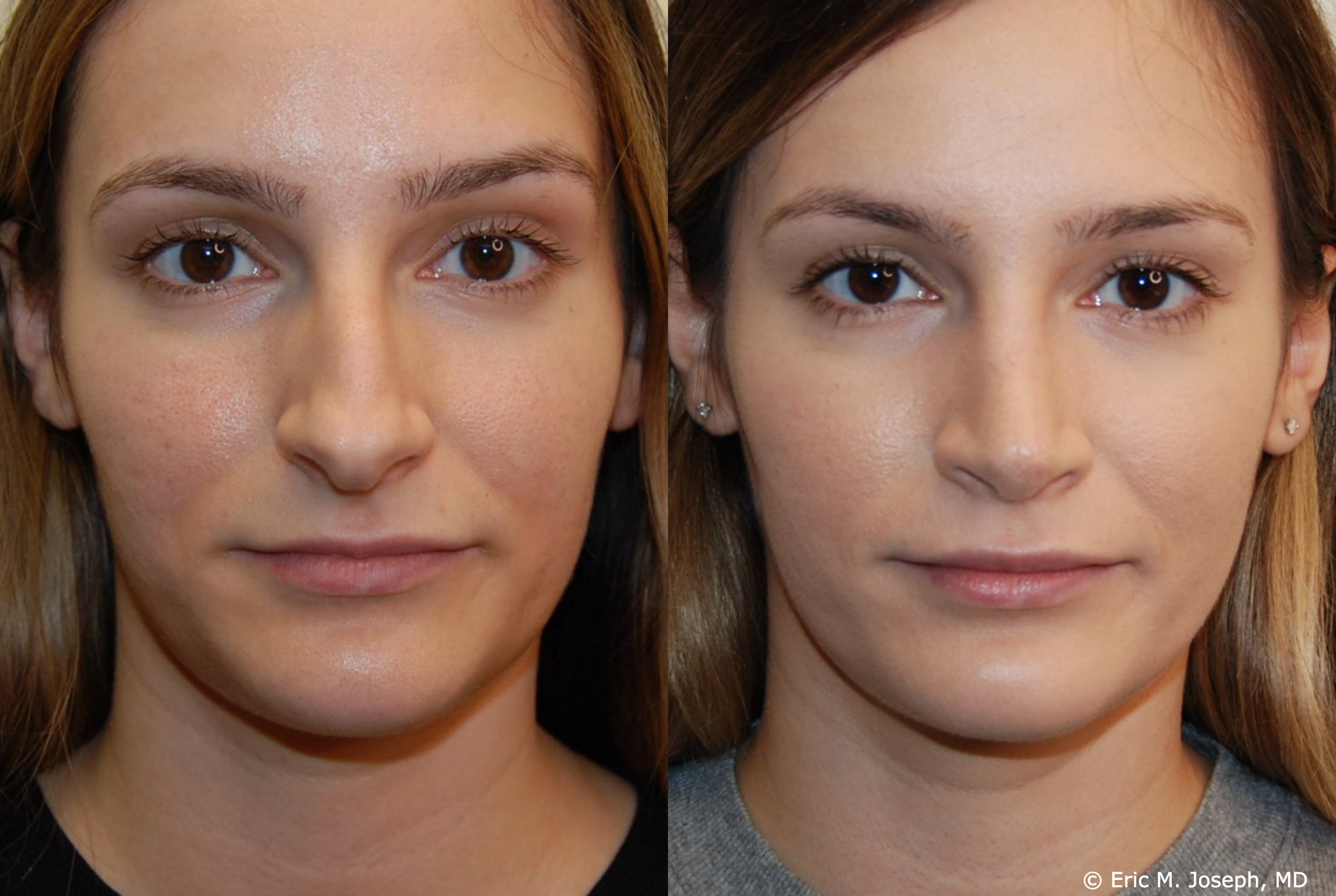 Eric M. Joseph, MD | Rhinoplasty Before & After: Results with Thin ...