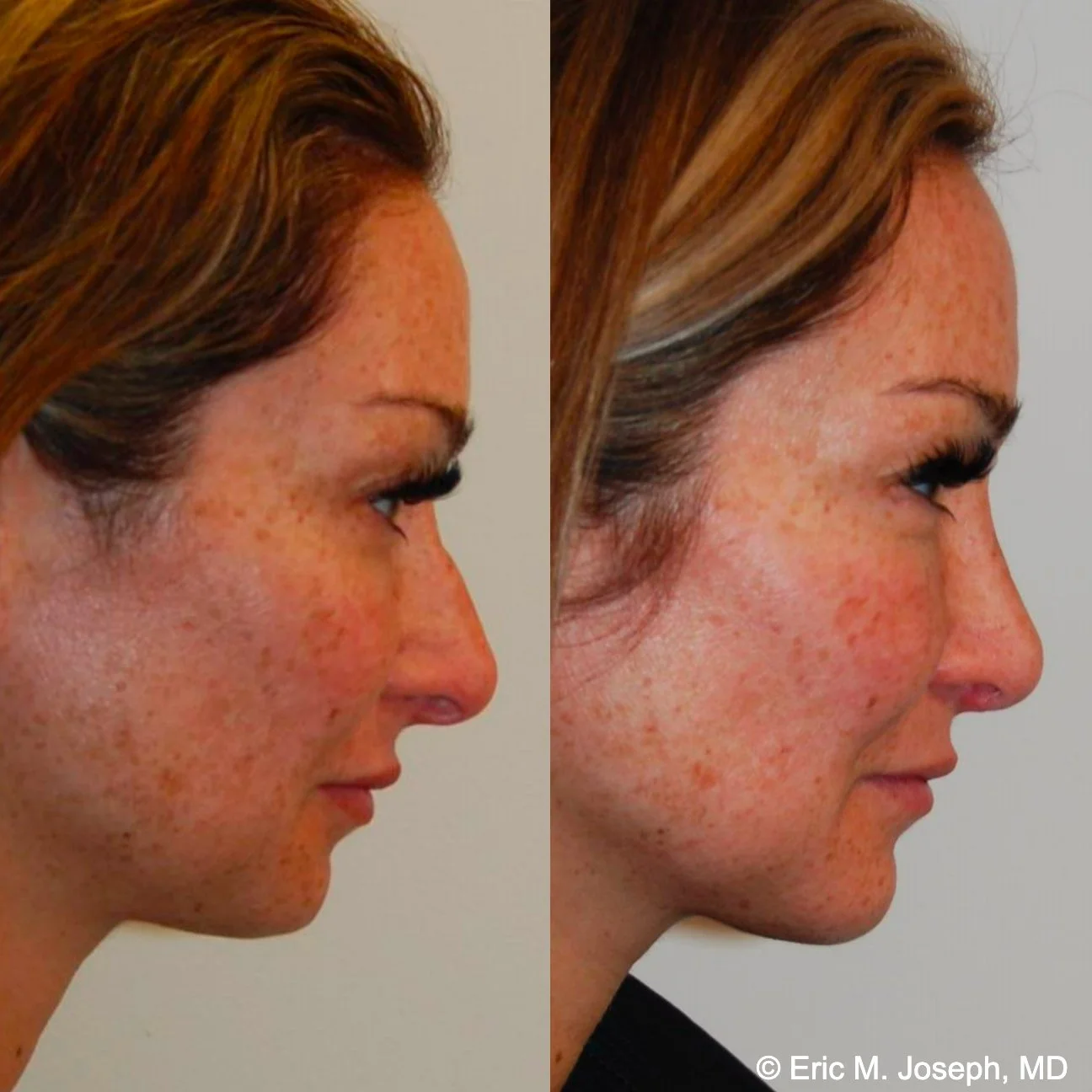 primary-rhinoplasty-nj-1285.jpg