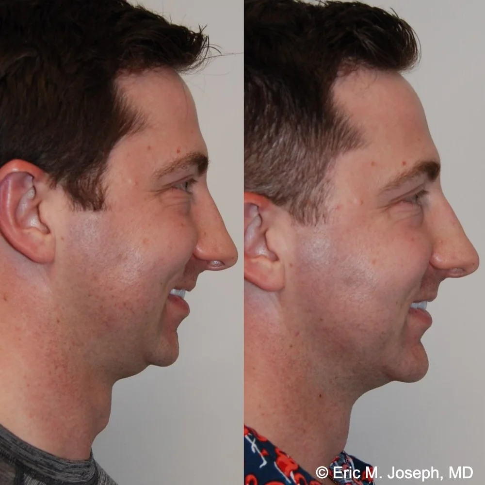 Eric M. Joseph, MD  Chin Implant Surgery Before & After Photos
