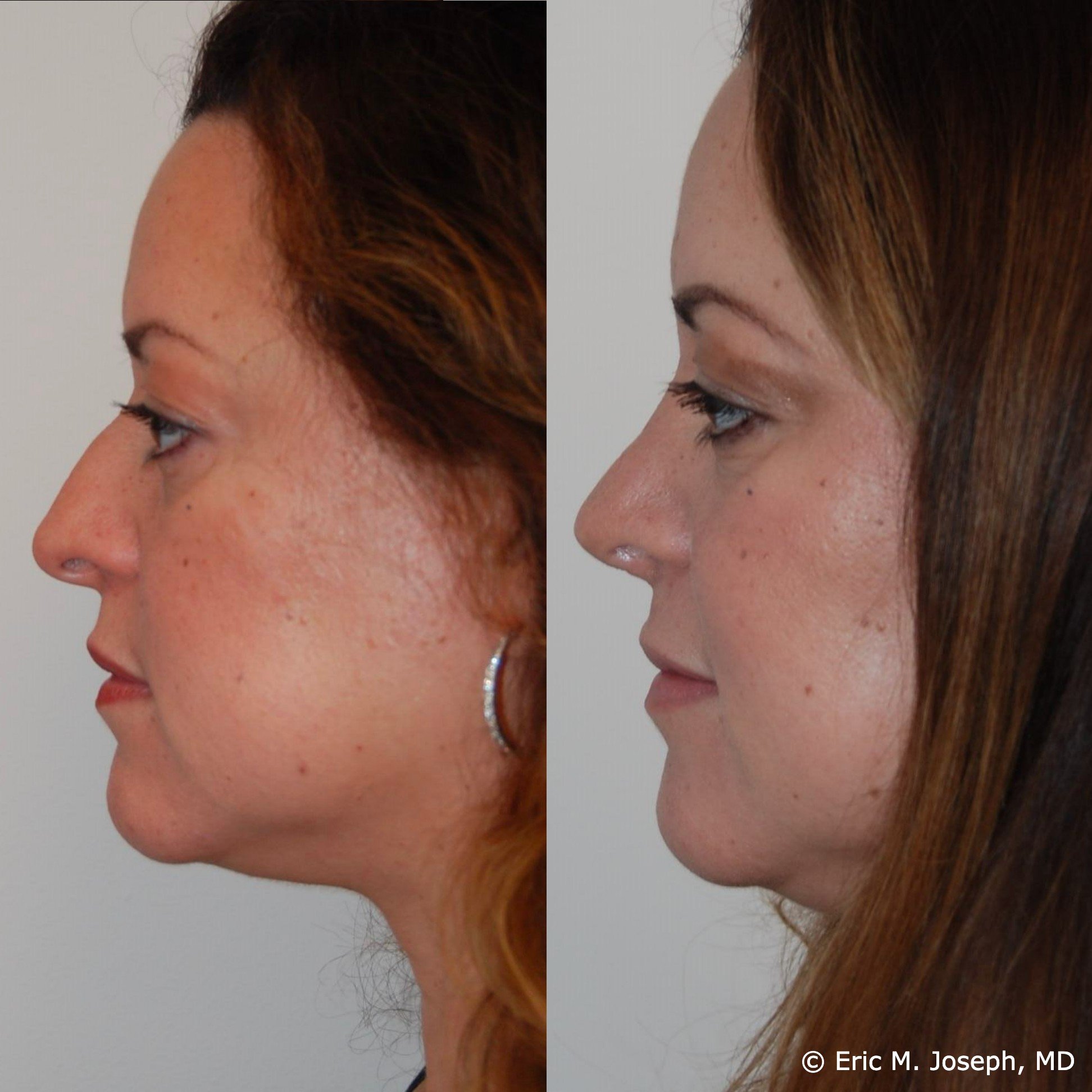 primary-rhinoplasty-nj1405.jpg