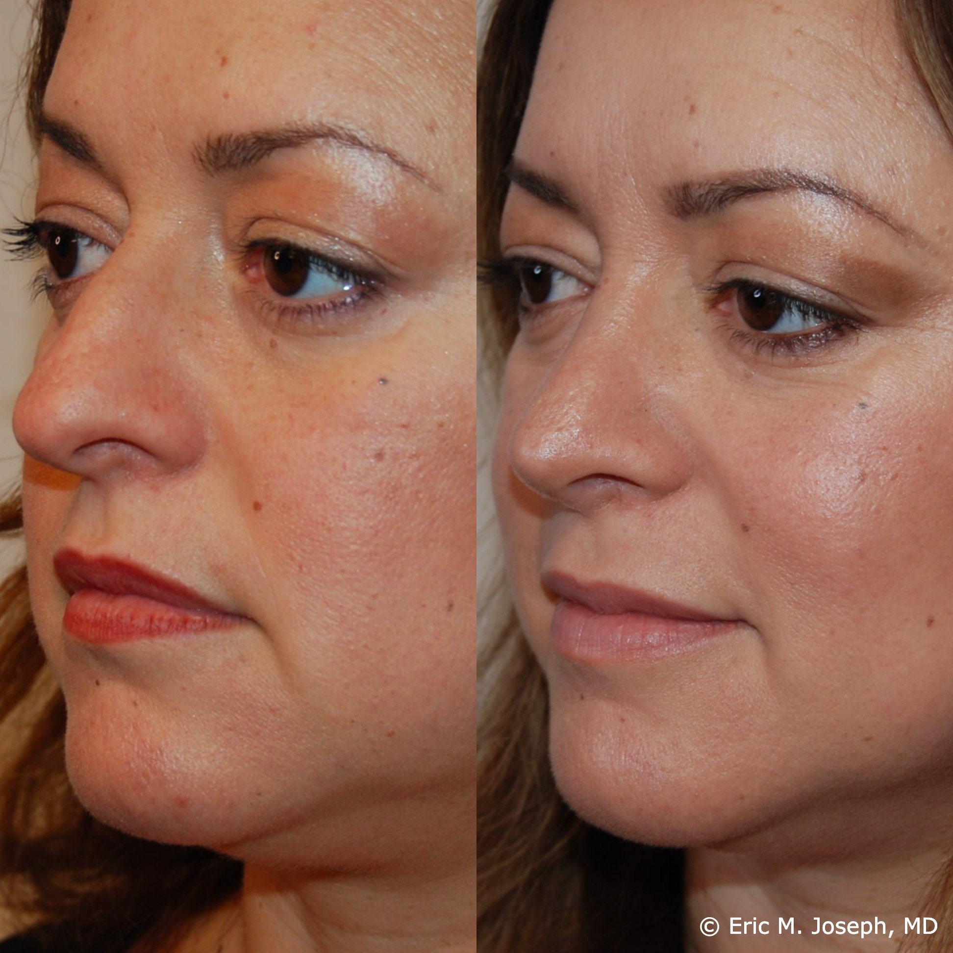 primary-rhinoplasty-nj1406.jpg