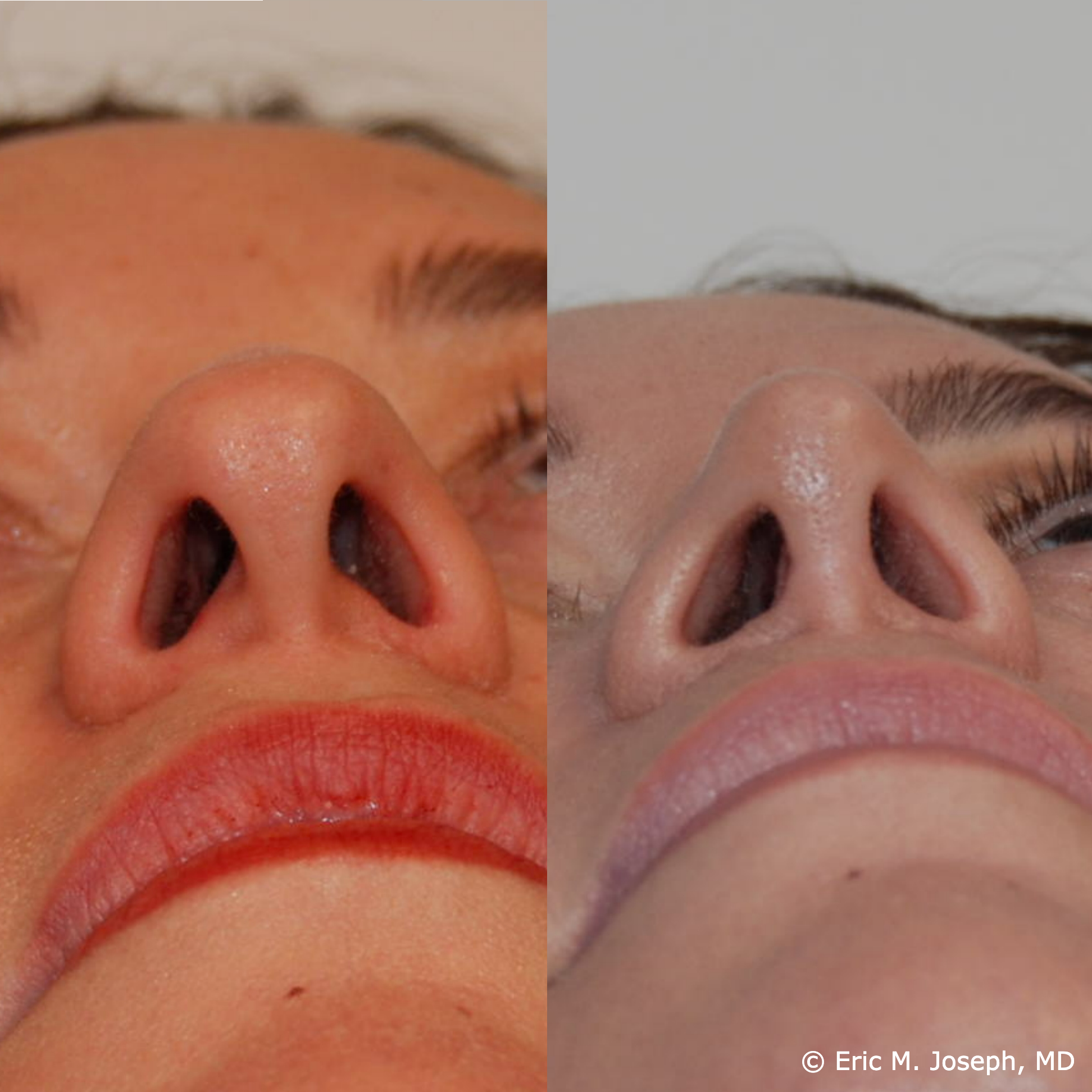 primary-rhinoplasty-nj1408.png