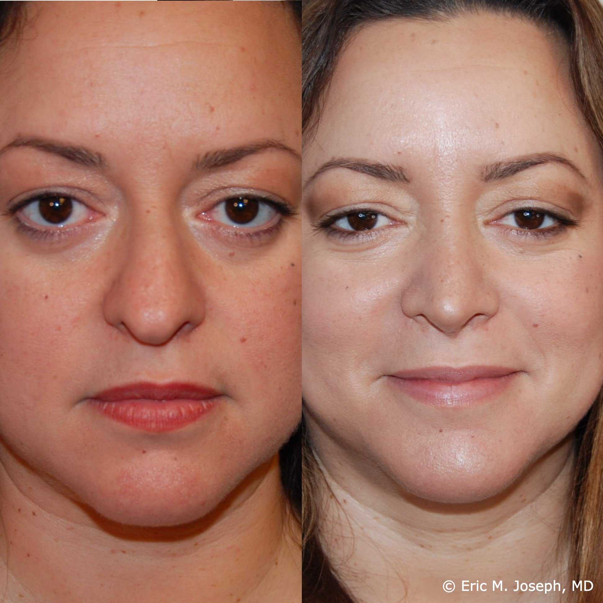 primary-rhinoplasty-nj1410.jpeg